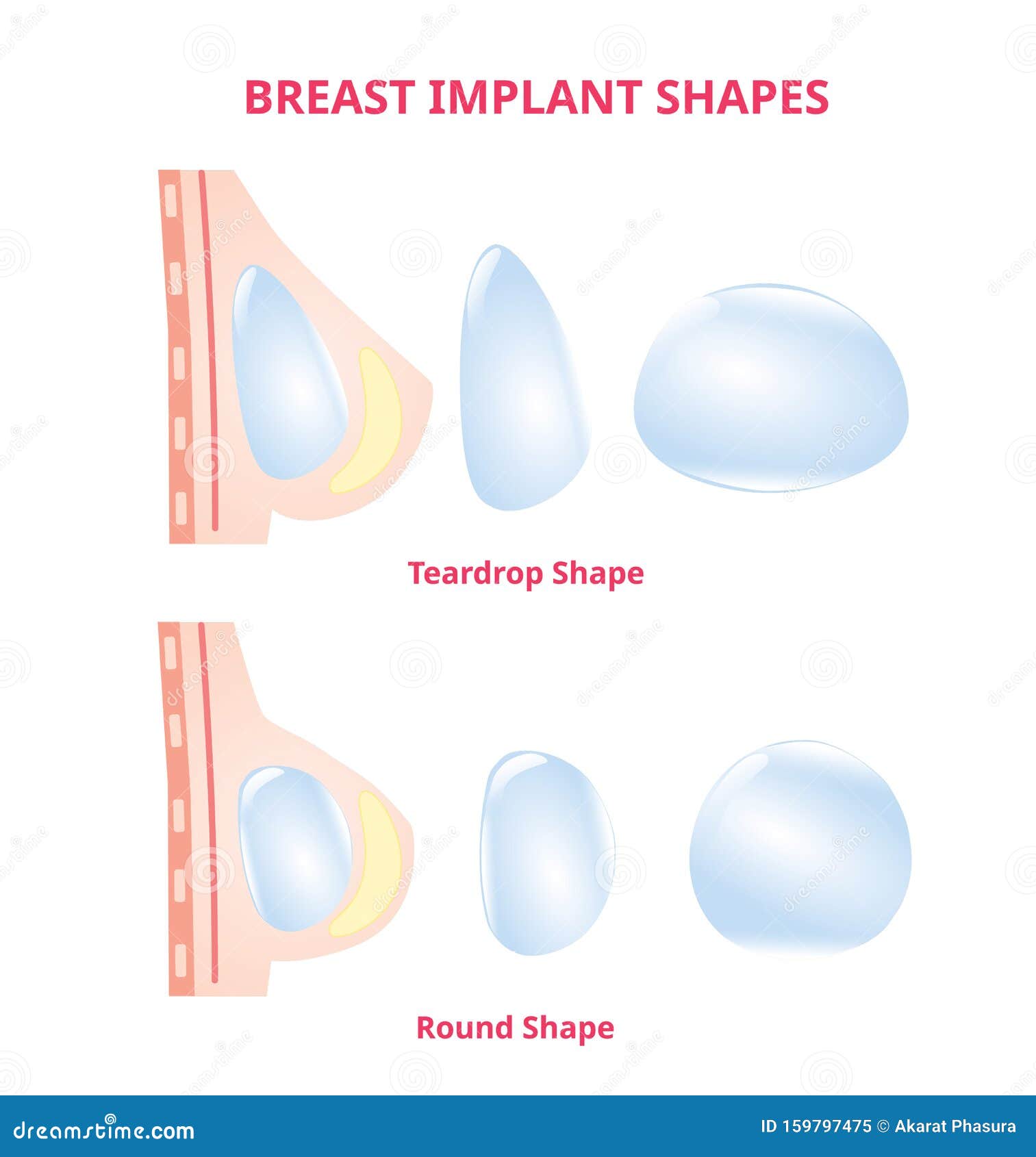 Breast Implant Silicone Compare Round and Tear Drop, Breast