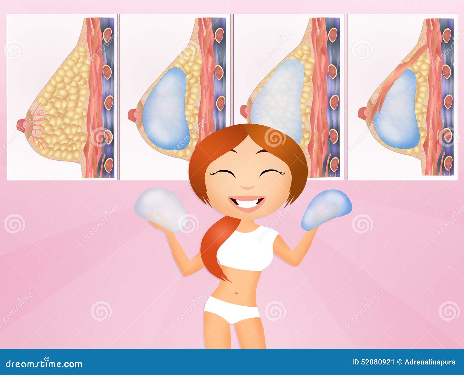 Female Breast Surgery Infographic Chart. Vector Flat Medical Illustration.  Set Of Human Breast Before And After With Different Implant On White  Background. Subglandular And Subpectorial Type. Royalty Free SVG, Cliparts,  Vectors, and