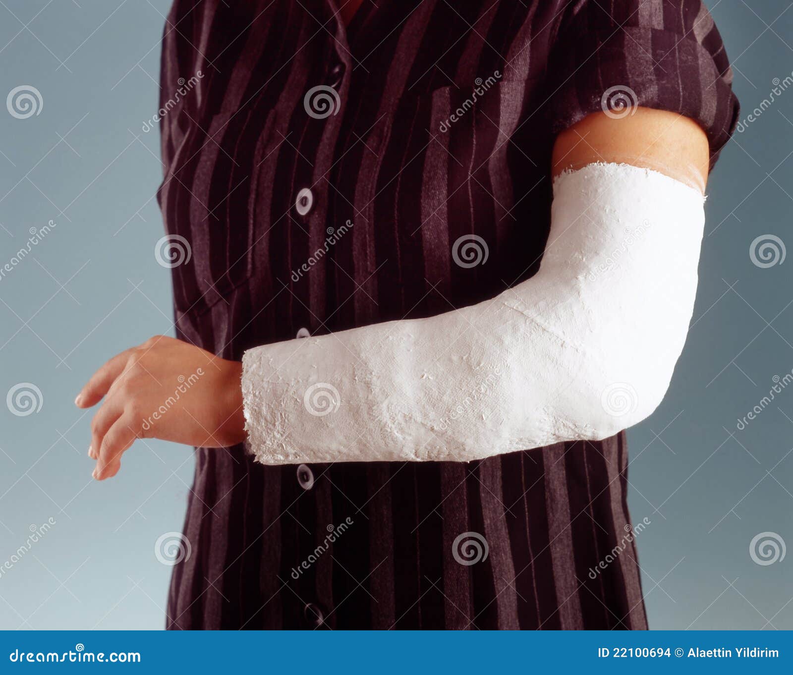 Broken arm stock photo. Image of childhood, fracture 22100694