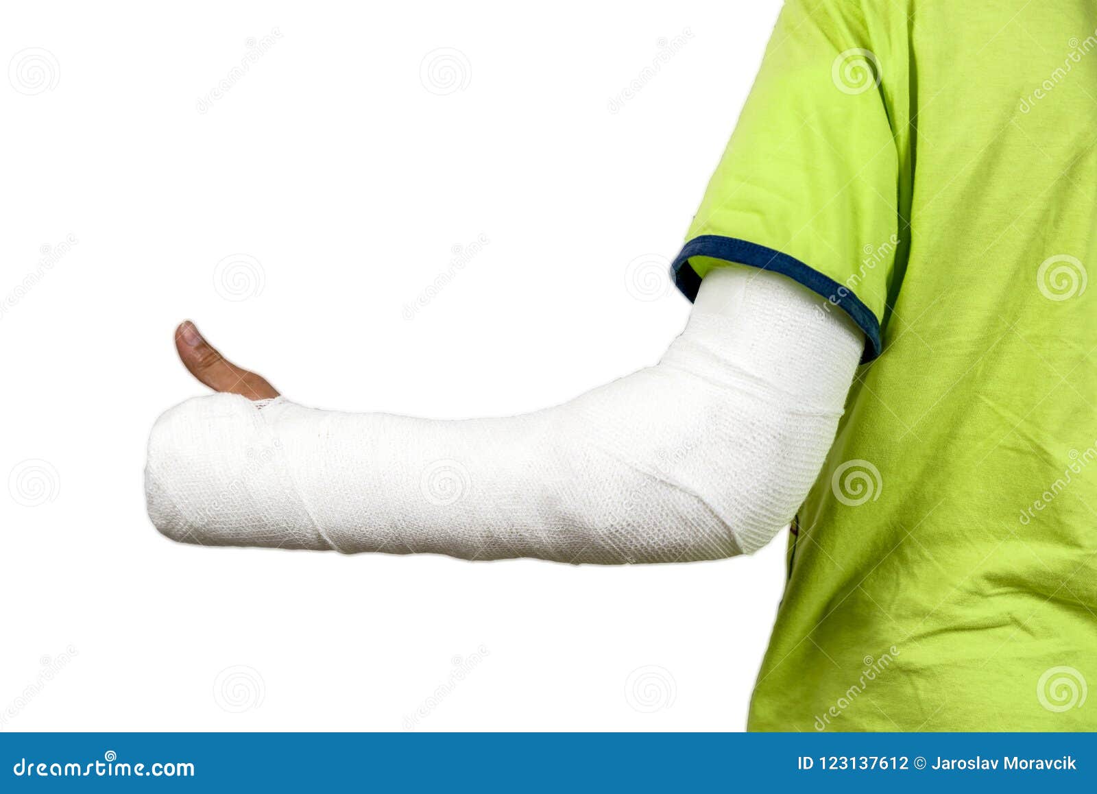 Broken hand in cast stock photo. Image of accident, isolated - 123137612