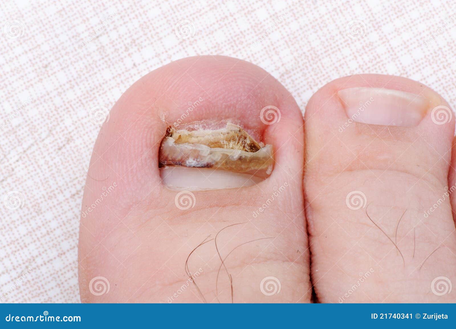 Broken ill nail on leg stock image. Image of infection 21740341