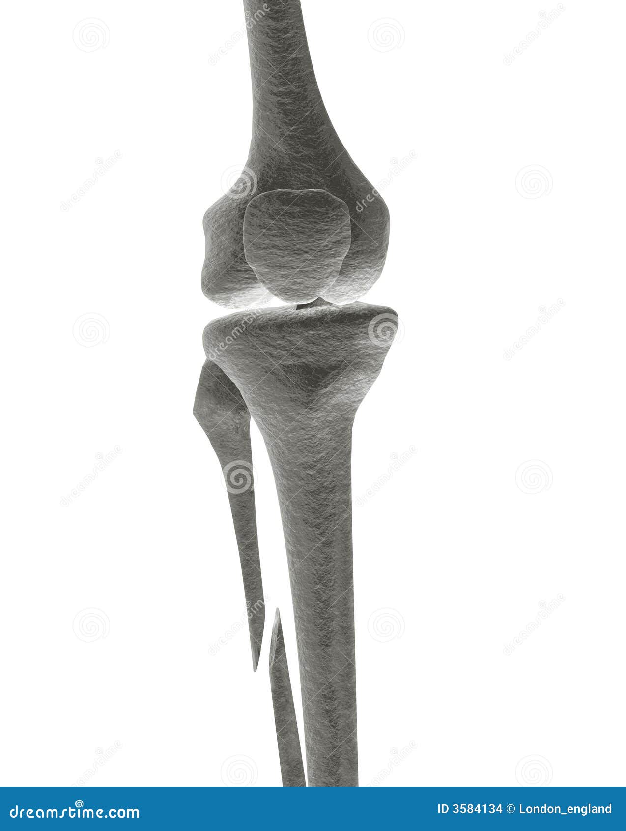 Broken Leg Bone X-ray Stock Images - Image: 3584134