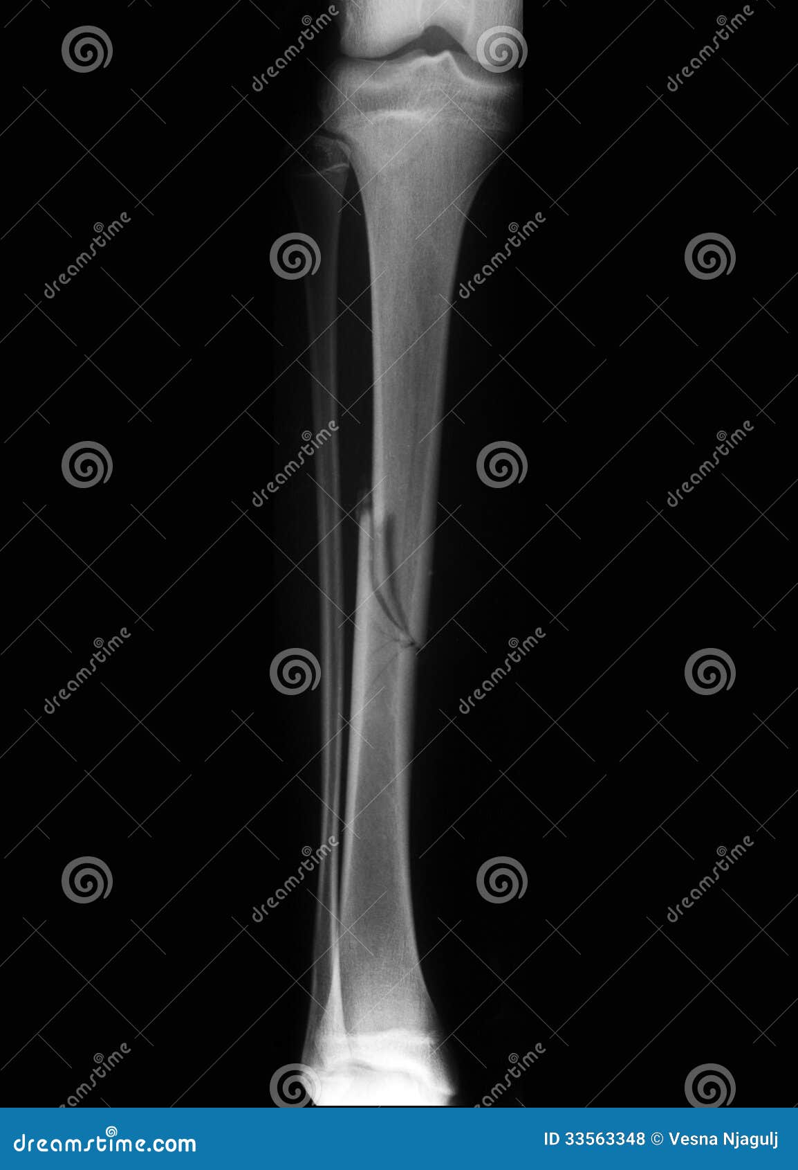 broken leg (broken tibia) radiography