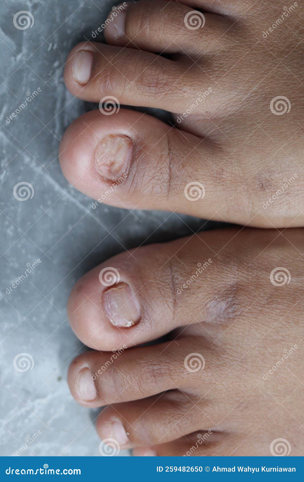 Broken nails stock photo. Image of care, infection, manicure 259482650