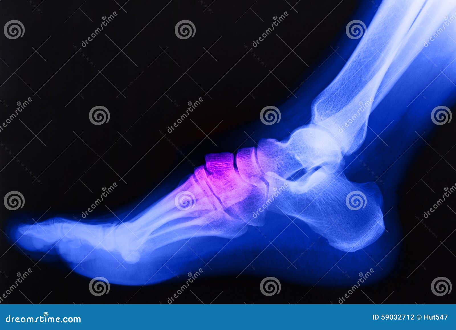 broken ankle xray broken ankle xray
