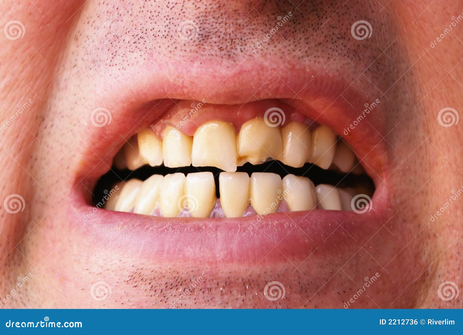 Download Dream Of Teeth Breaking Images - Teeth Walls Collection For