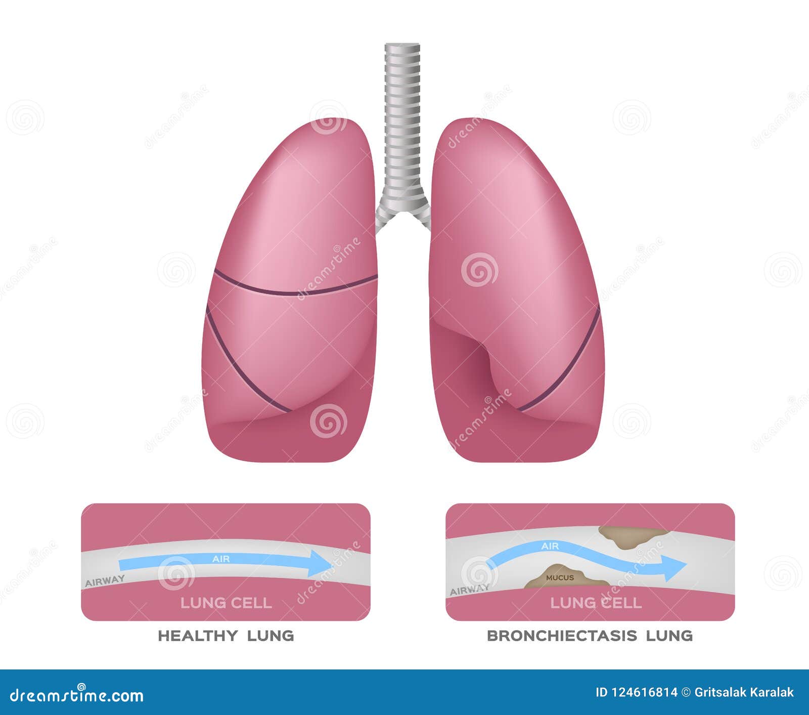 Bronchiectasis in Lung Infographic Stock Vector Illustration of