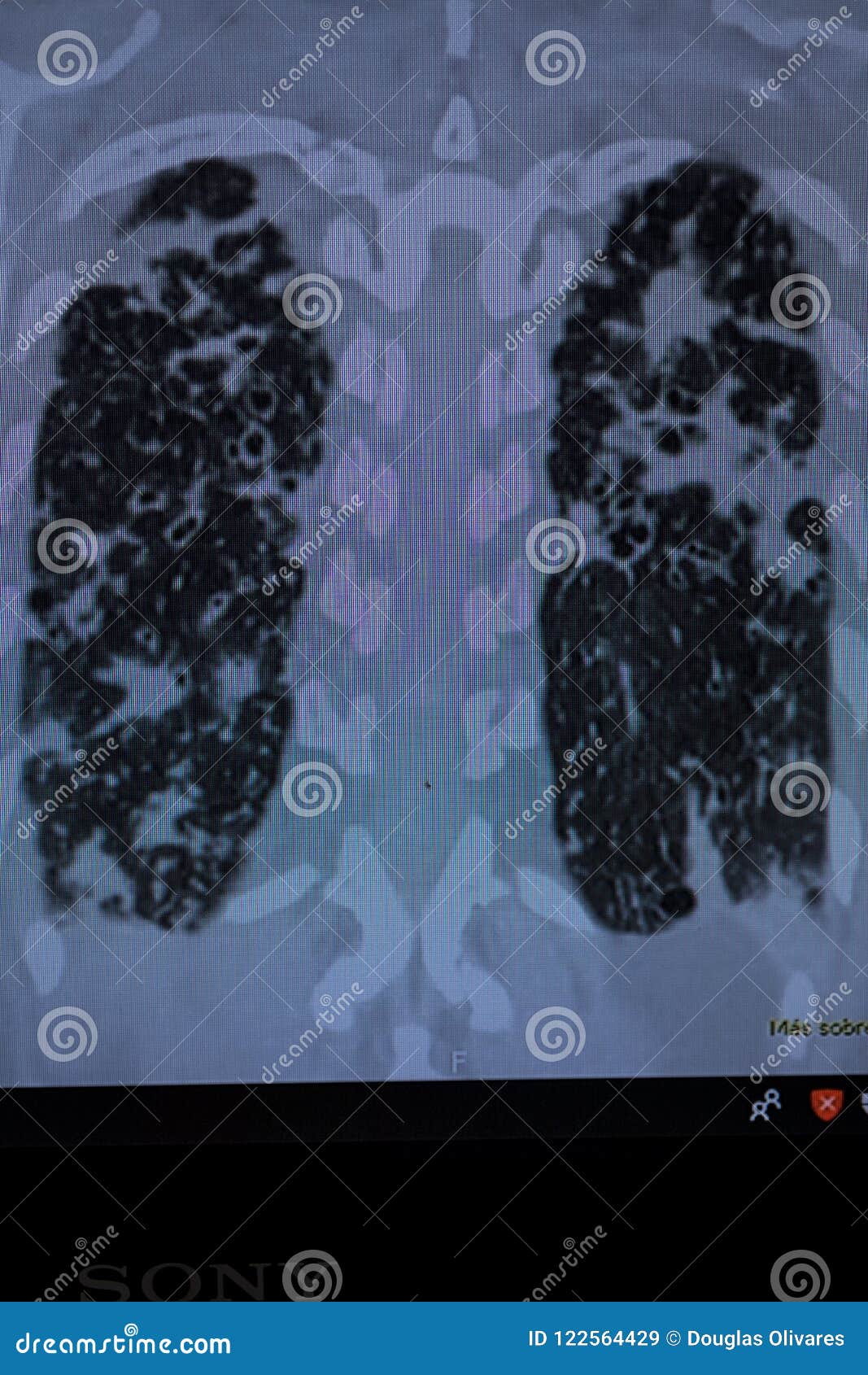 Bronchiectasis And Pulmonary Tb Stock Image Image Of Healthcare