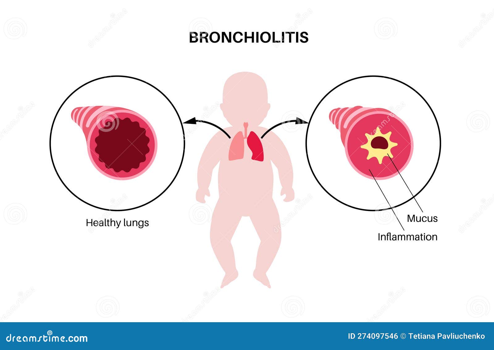 Bronchiolitis Lung Disease Vector Illustration CartoonDealer bronchiolitis-lung-disease-vector-illustration-cartoondealer