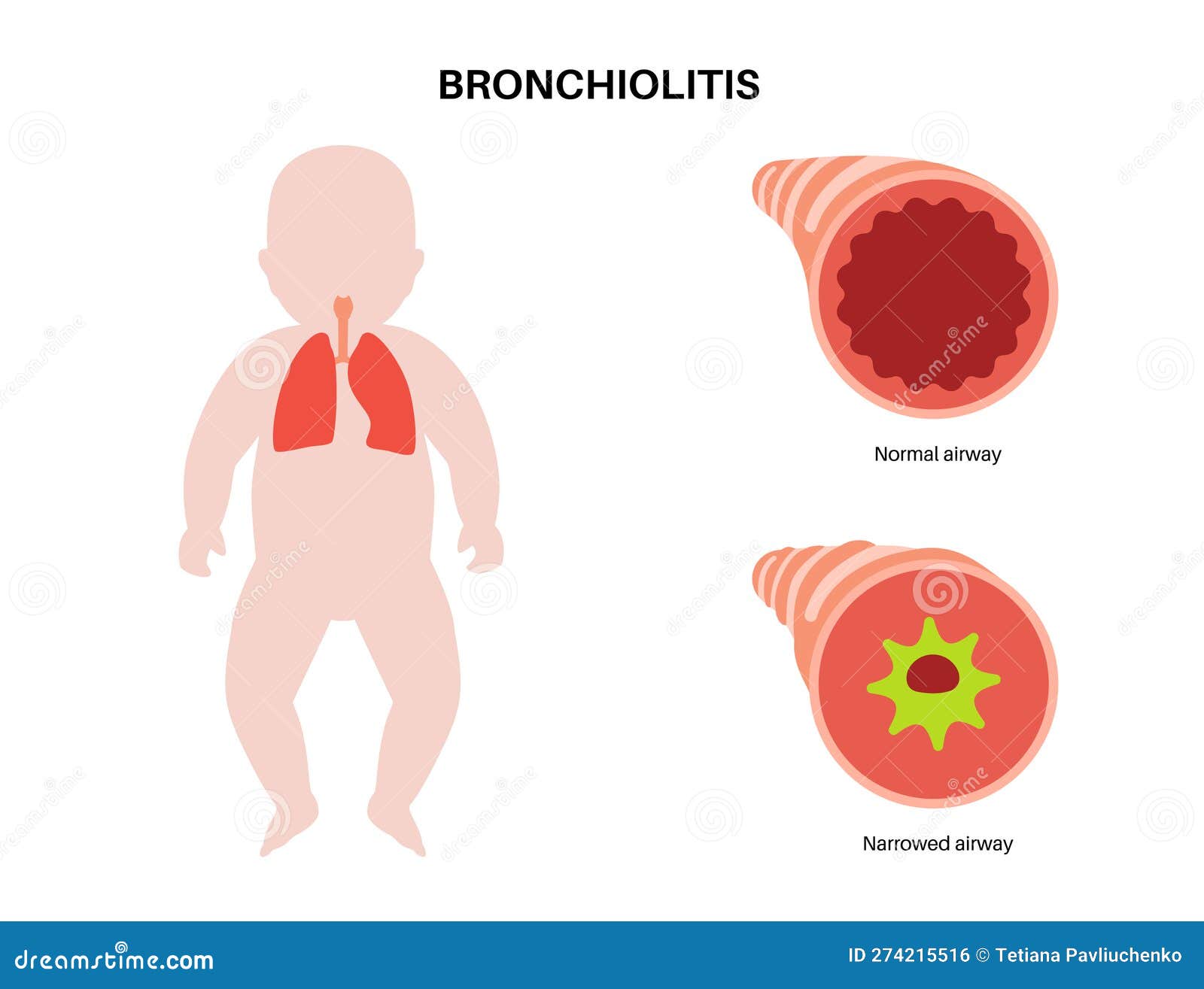 Bronchiolitis Lung Disease Vector Illustration CartoonDealer bronchiolitis-lung-disease-vector-illustration-cartoondealer