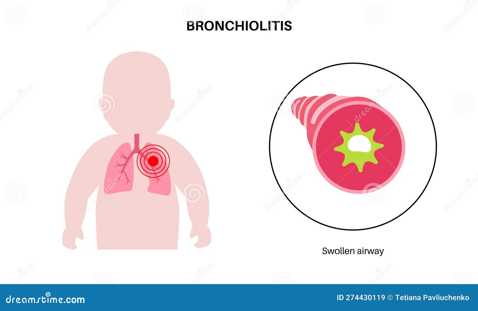 Bronchiolitis Lung Disease Cartoon Vector CartoonDealer 274430119 pin-by-flashuni-nurses-on-nursing-chest-pain-costochondritis