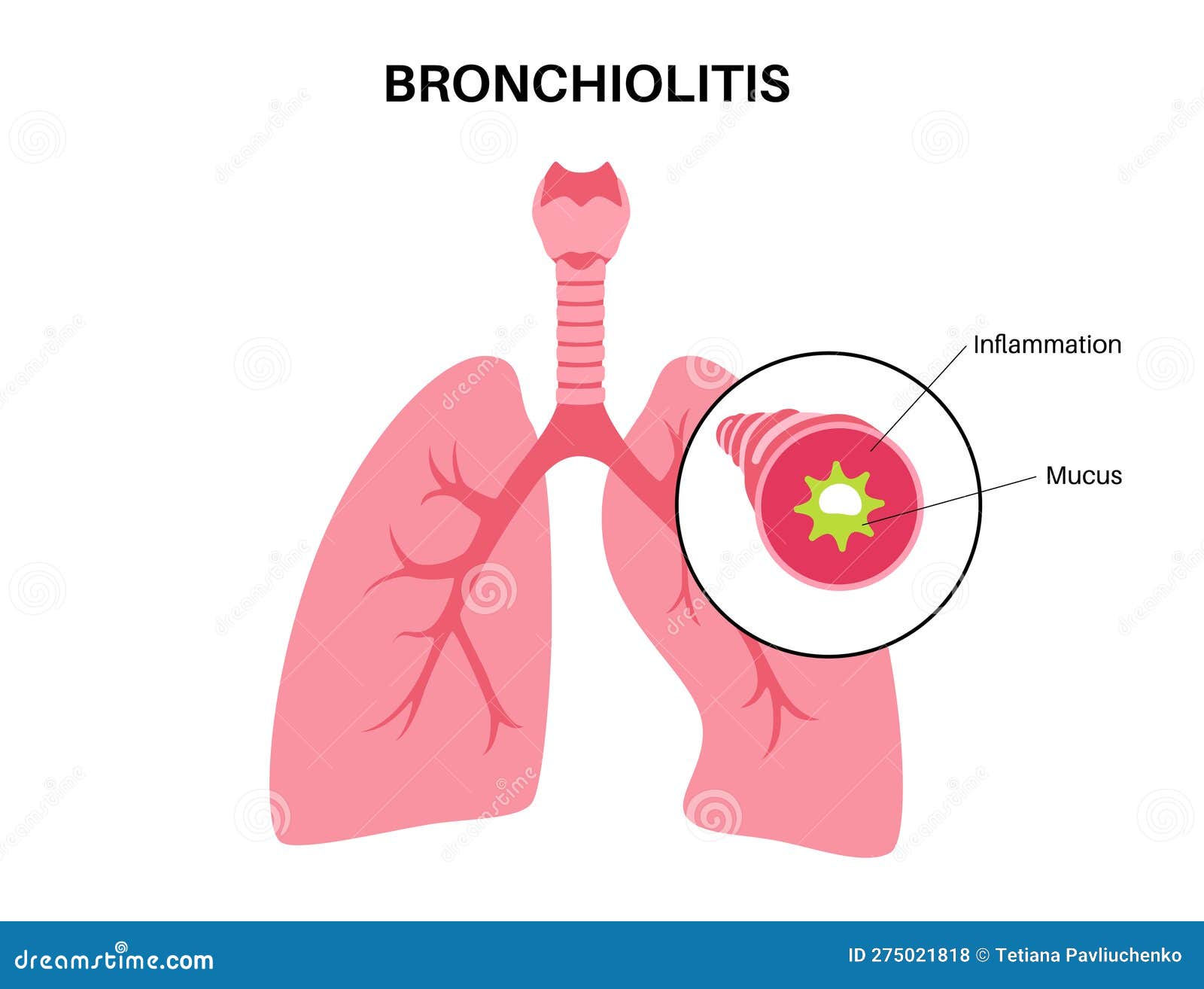 Bronchiolitis Lung Disease Vector Illustration CartoonDealer bronchiolitis-lung-disease-vector-illustration-cartoondealer