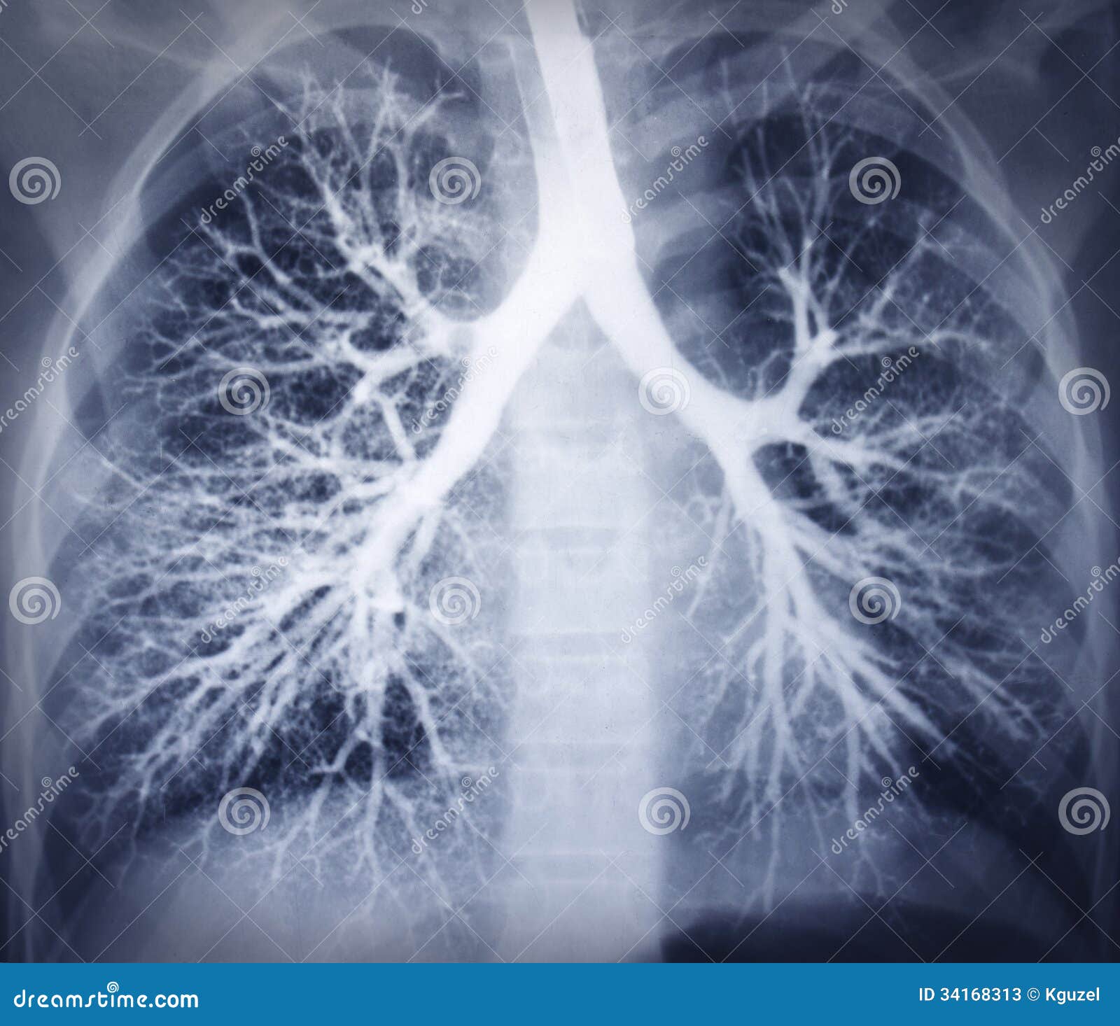 bronchoscopy image. chest x-ray. healthy lungs