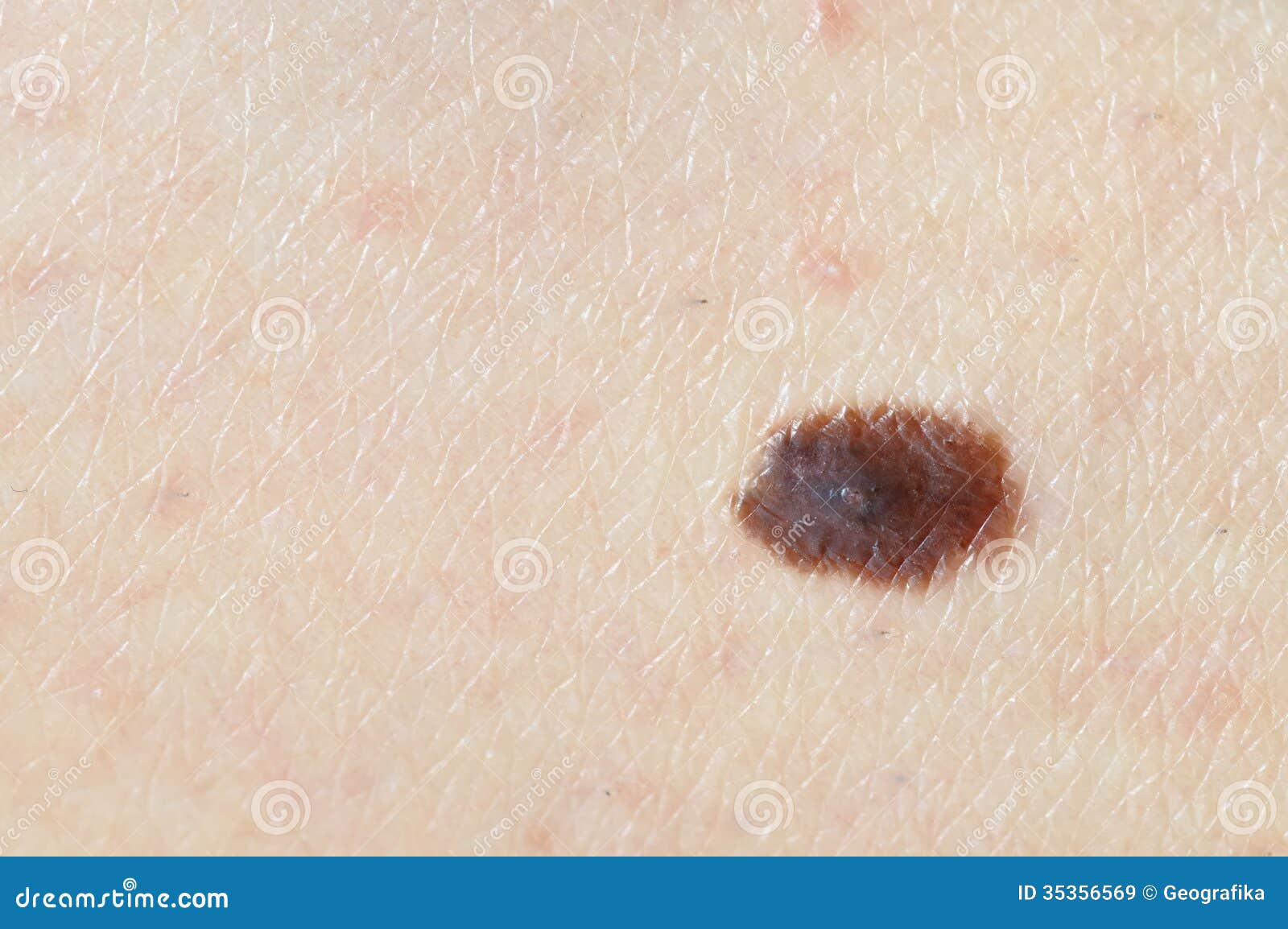 brown birthmark (nevus) on caucasian woman leg.