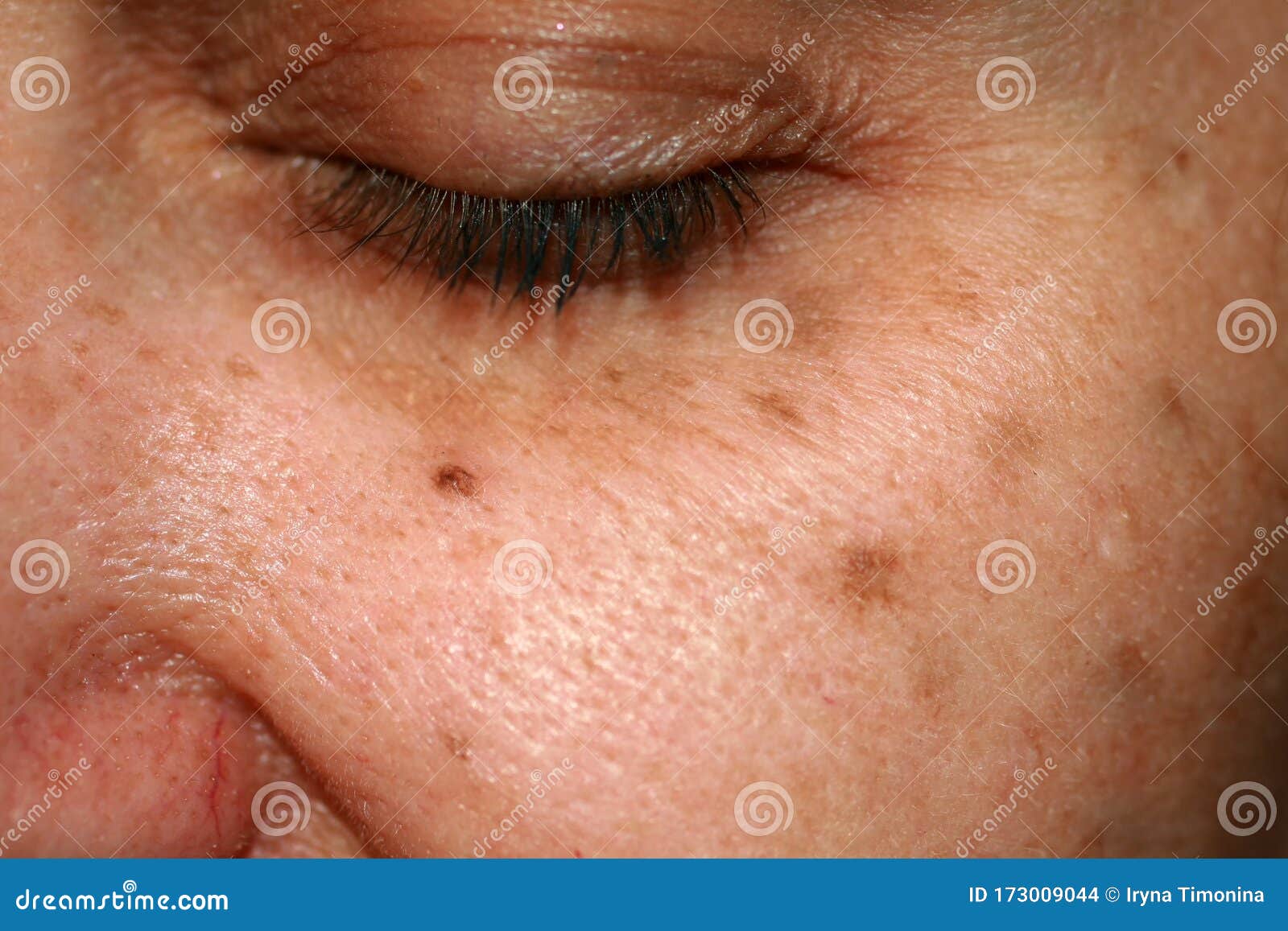 skin pigmentation brown patches