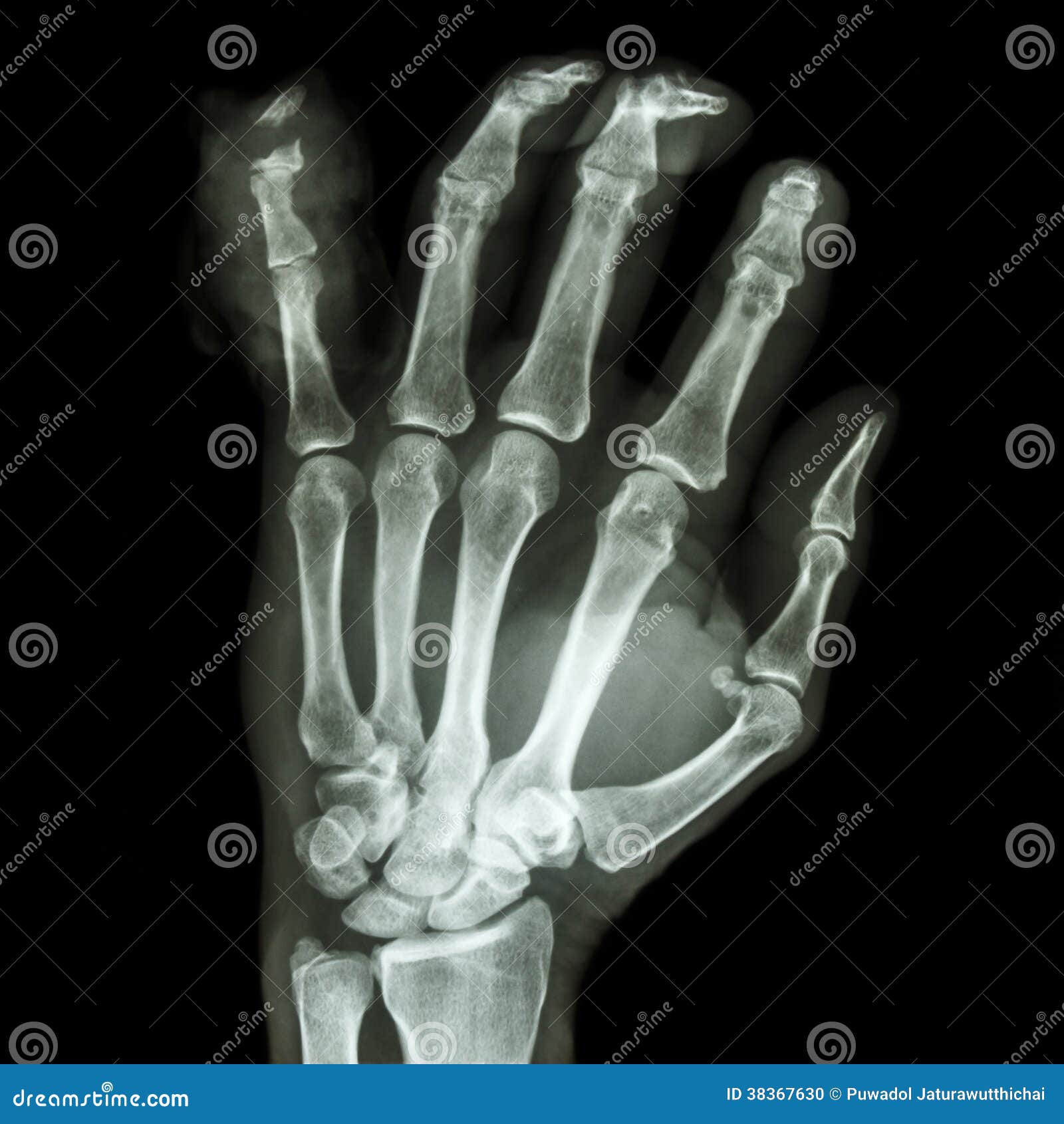 Bruch Distaler Pharange Kleiner Finger Stockfoto - Bild von krankheit,  orthopädisch: 38367630