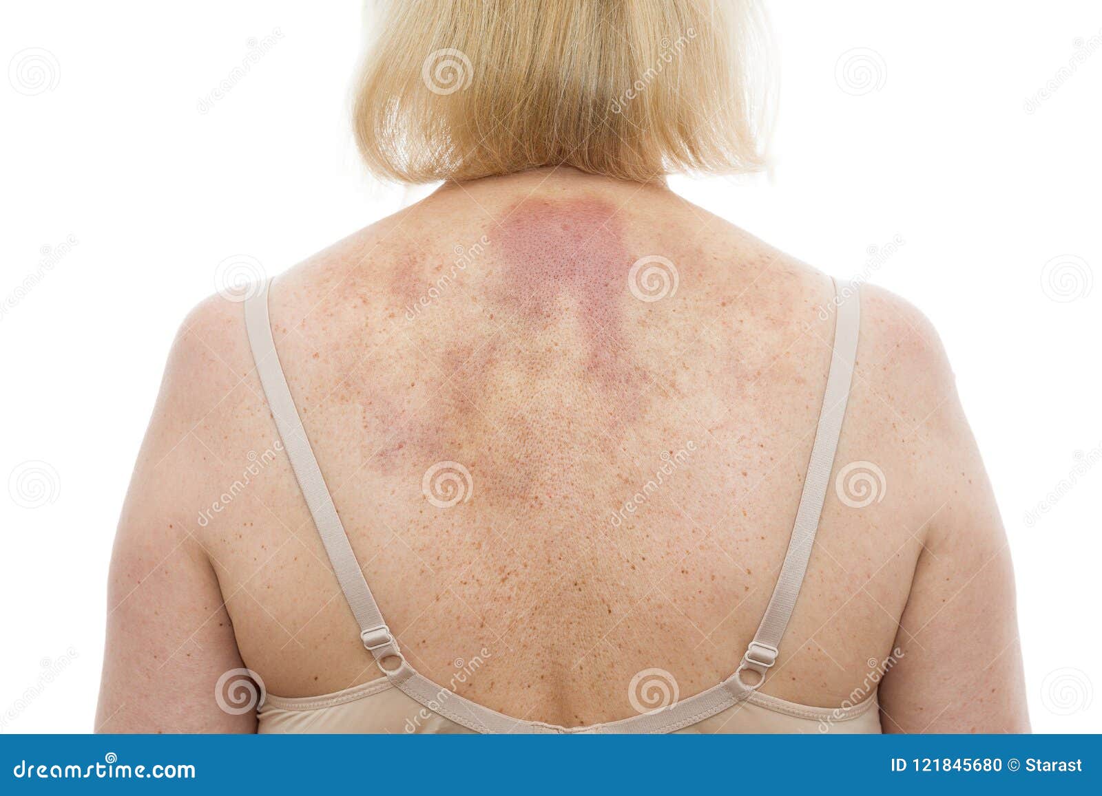 bruising from deep tissue massage bruising from deep tissue massage