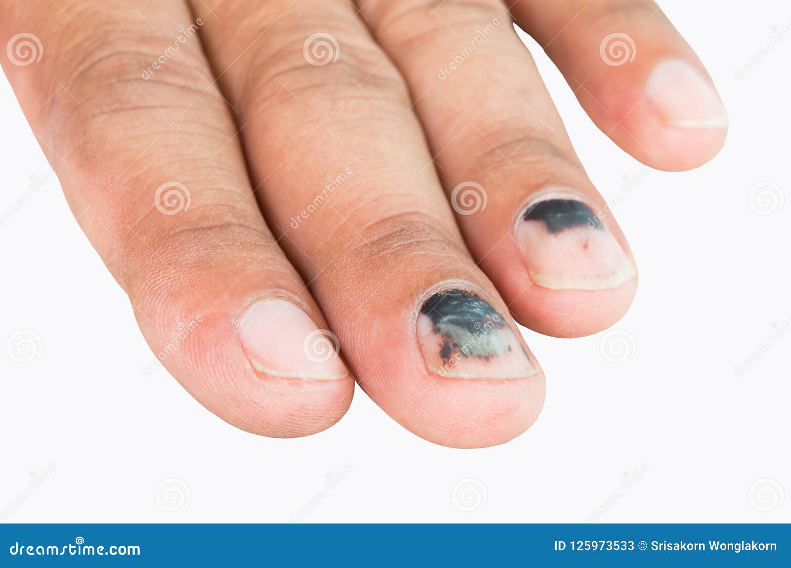 Bruise on the Finger from the Accident. Stock Image Image of human