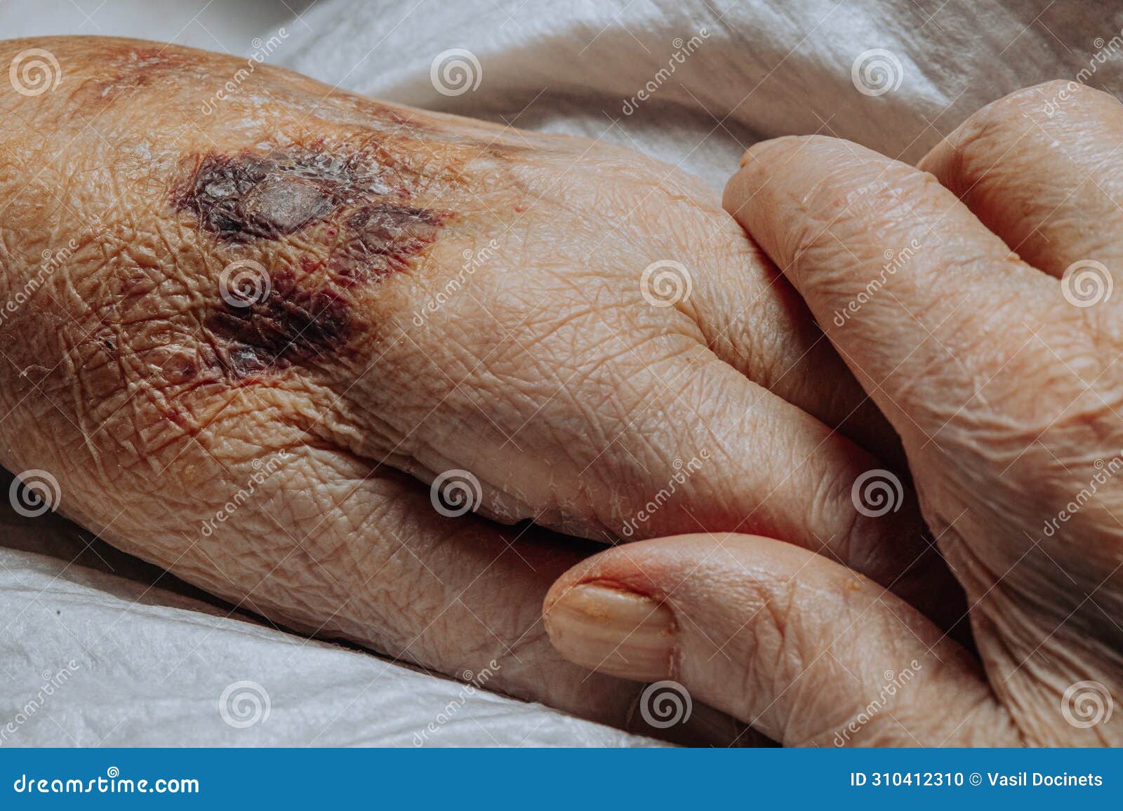 a bruise on the hand of an elderly person. known as senile purpura.