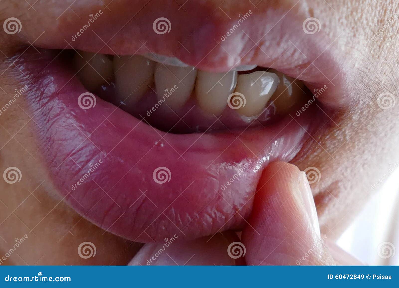 Bruise at the lip stock image. Image of person, domestic 60472849