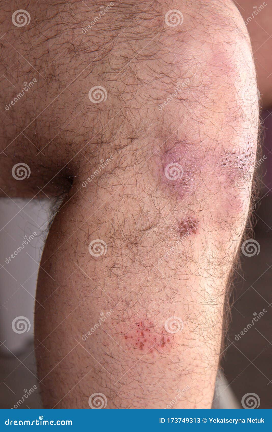 Bruise and Bruise on a Man Knee Stock Image Image of painful, fester
