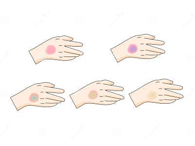 Bruise Stages Diagram Medical Science Stock Illustration - Illustration ...