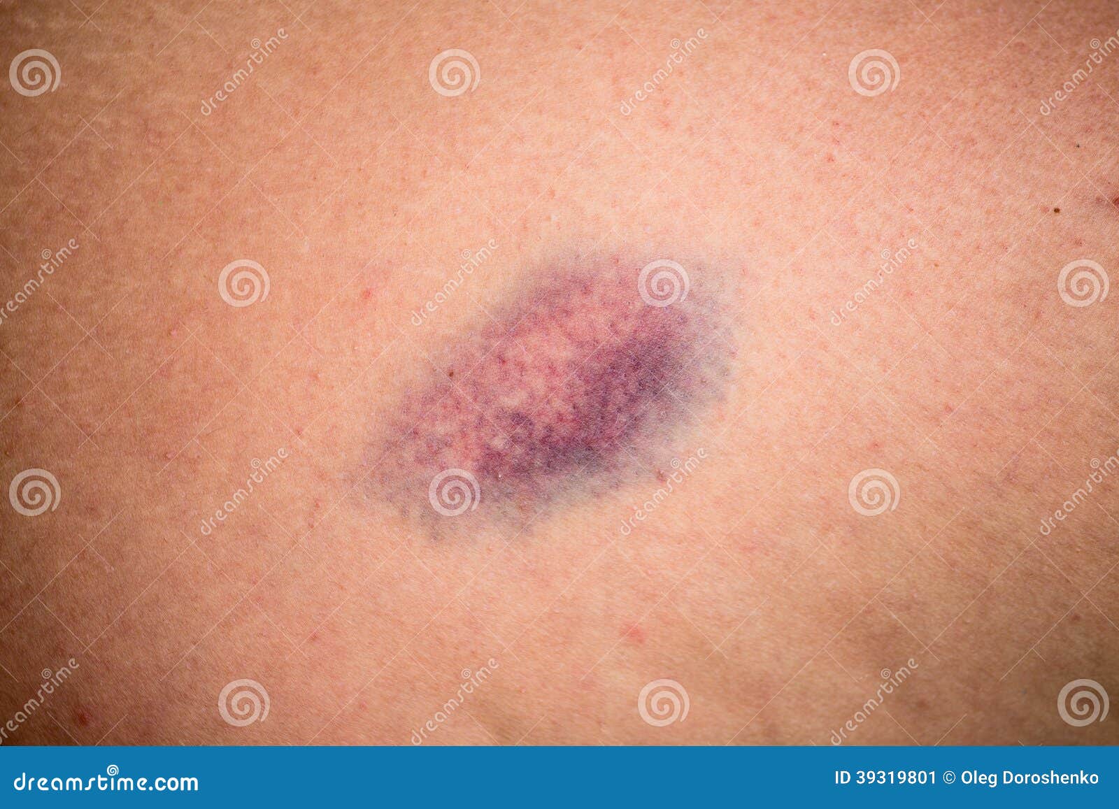 Picture Of Woman Wounded Leg 116