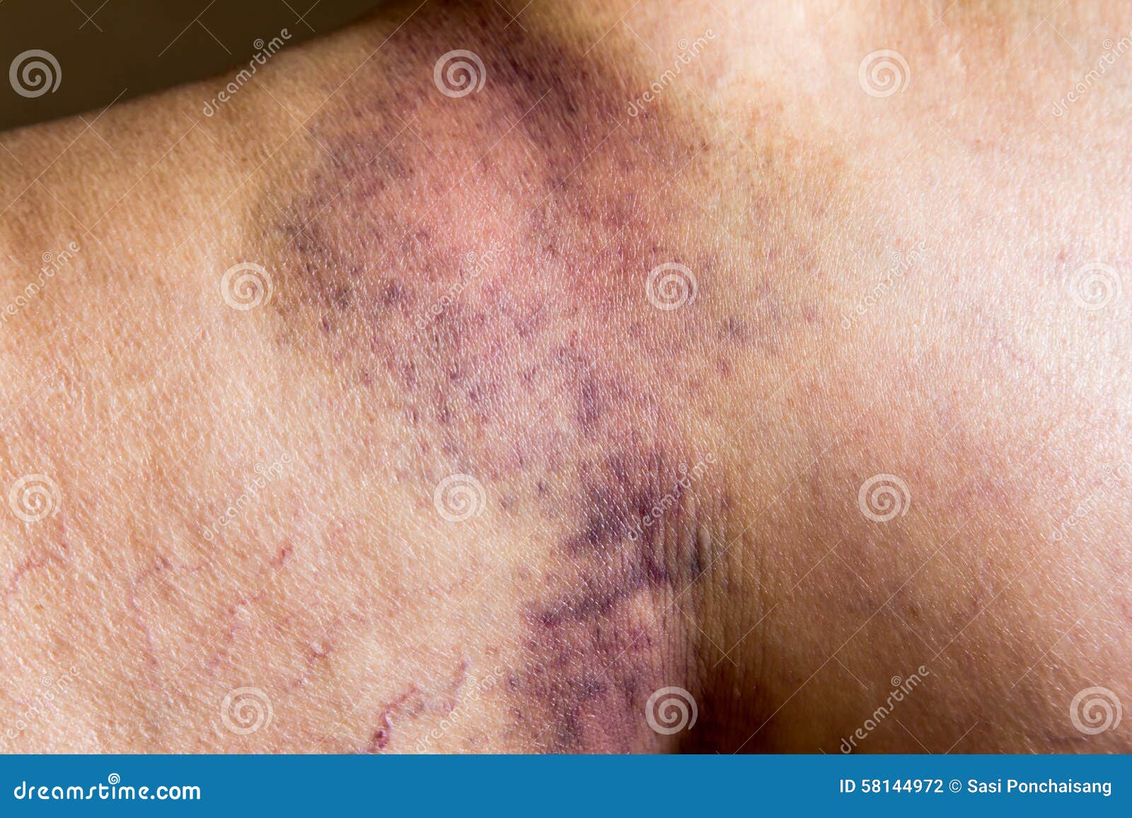 Picture Of Woman Wounded Leg 20