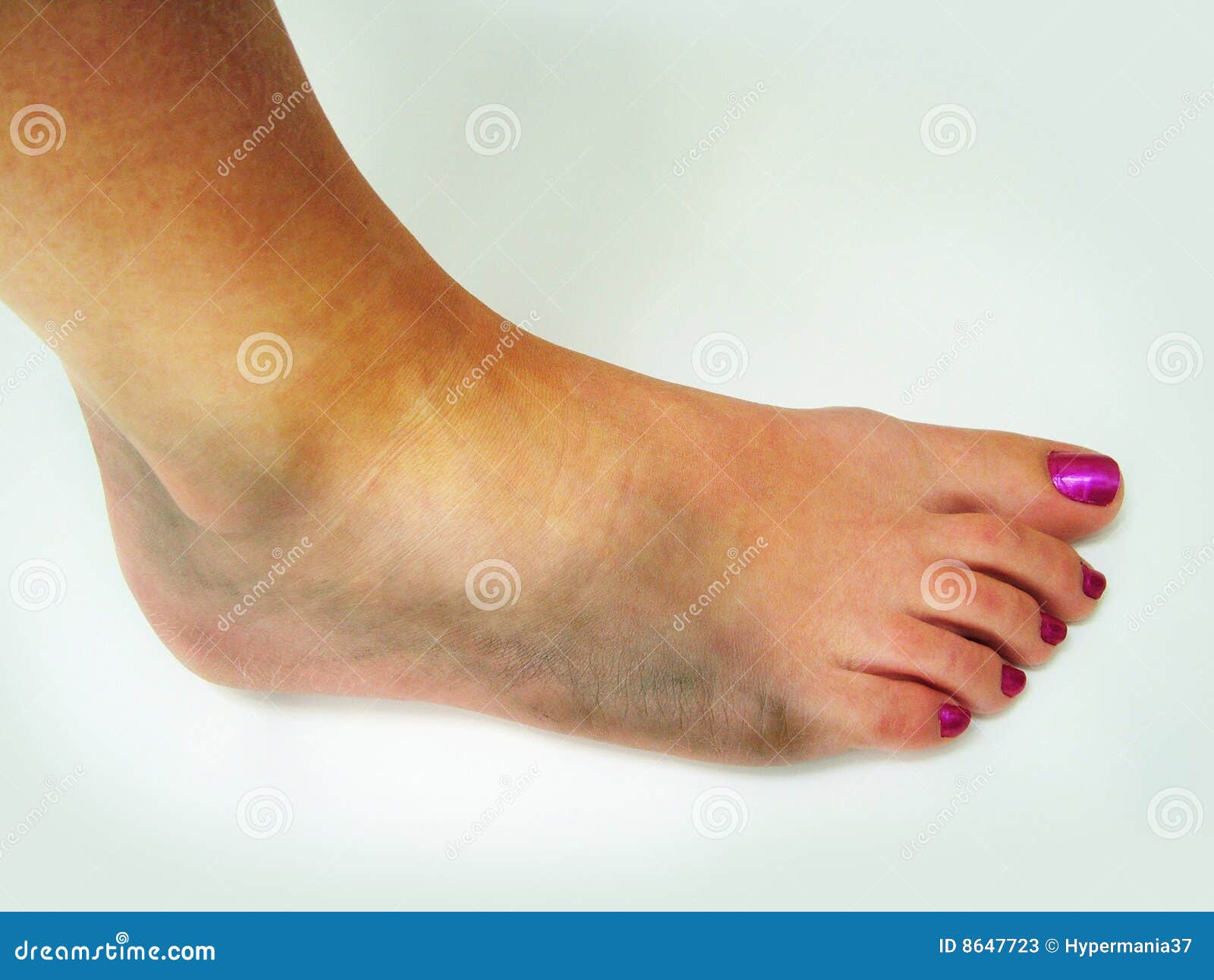 Image of Bruised ankle with swelling and discoloration following an ankle sprain.