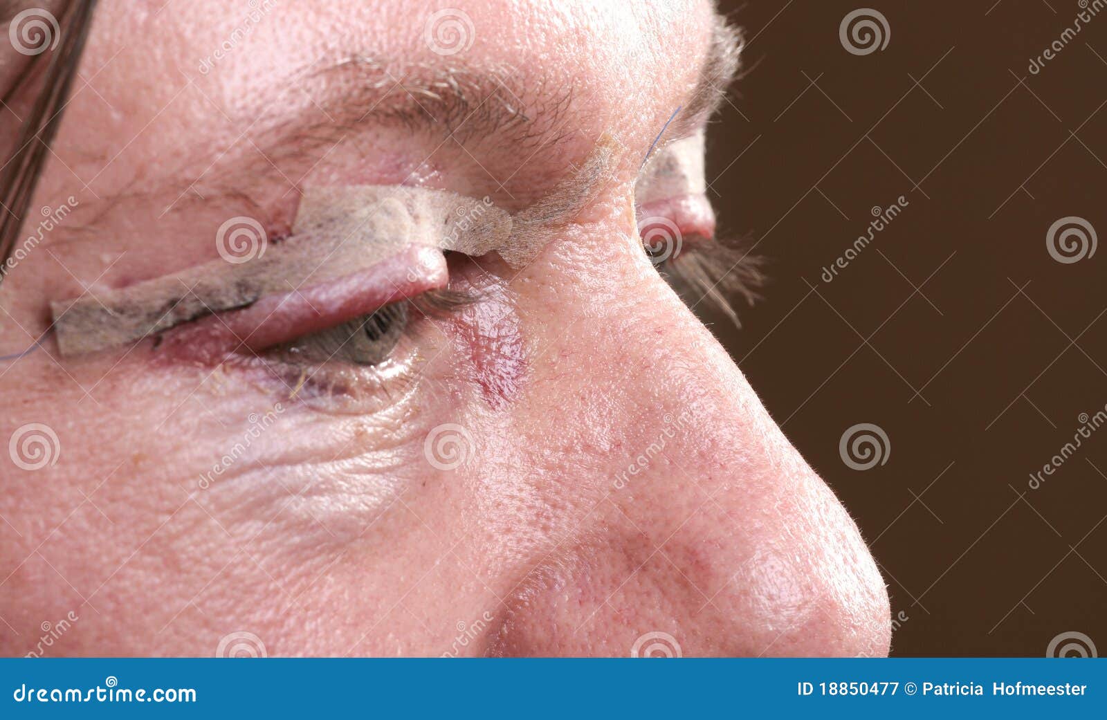 Bruised eye after surgery stock image. Image of lift 18850477