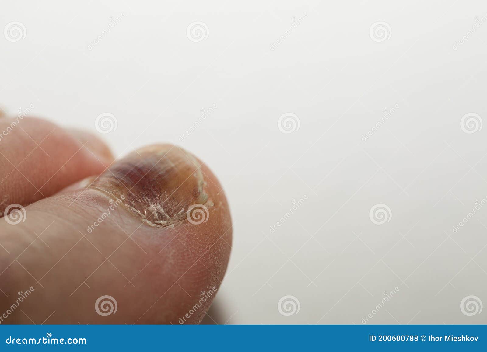 A Bruised Finger after a Blow, a Bruise on the Finger Stock Photo