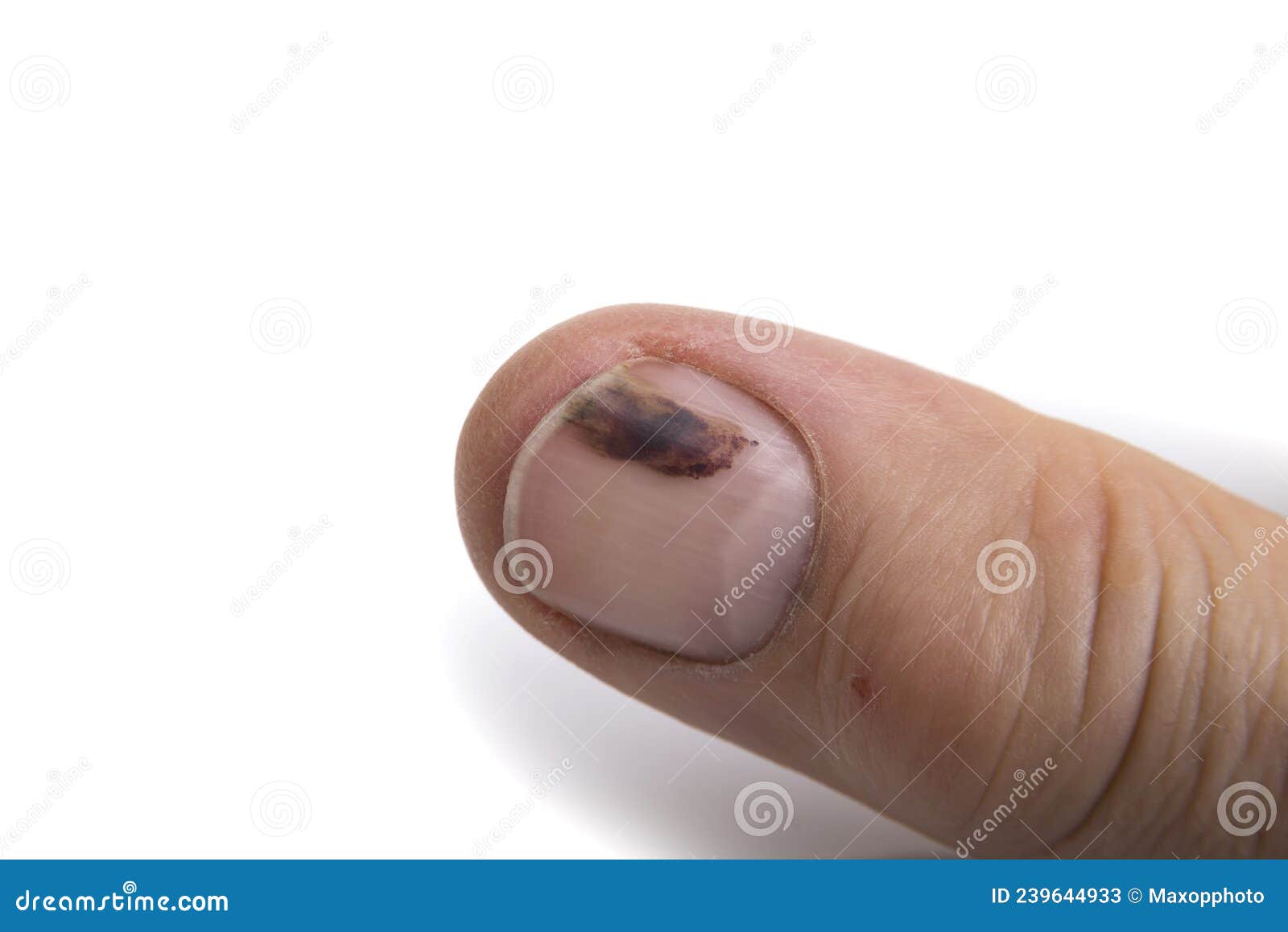 A Bruised Fingernail at a White Background Stock Image Image of