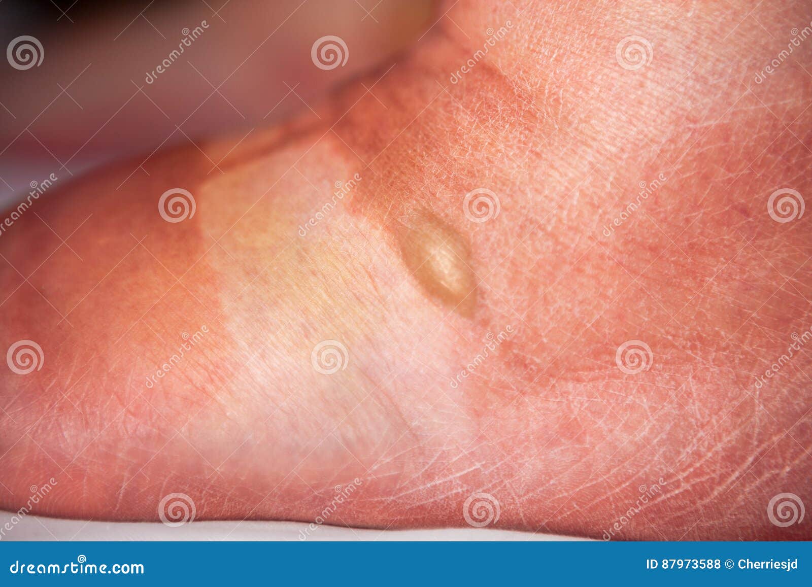 Bruised Foot with Burn Blisters Stock Photo Image of copy, problem