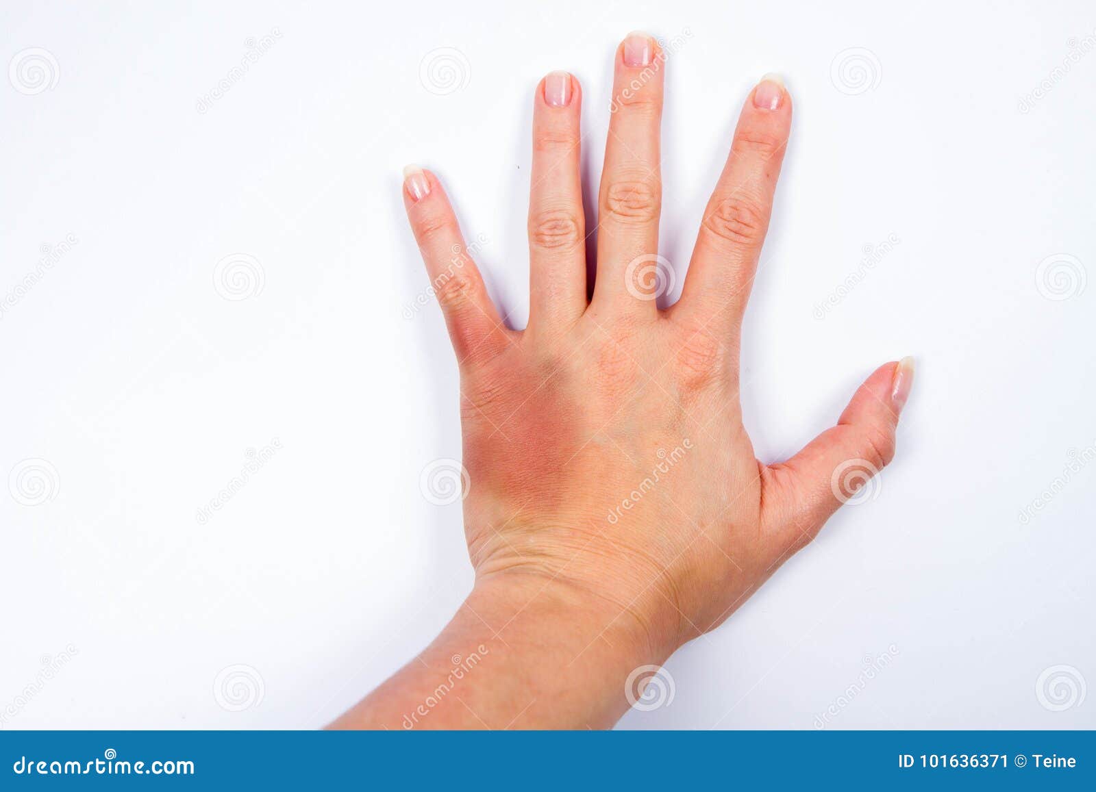 Bruised hand stock image. Image of hand, autopsy, beat 101636371