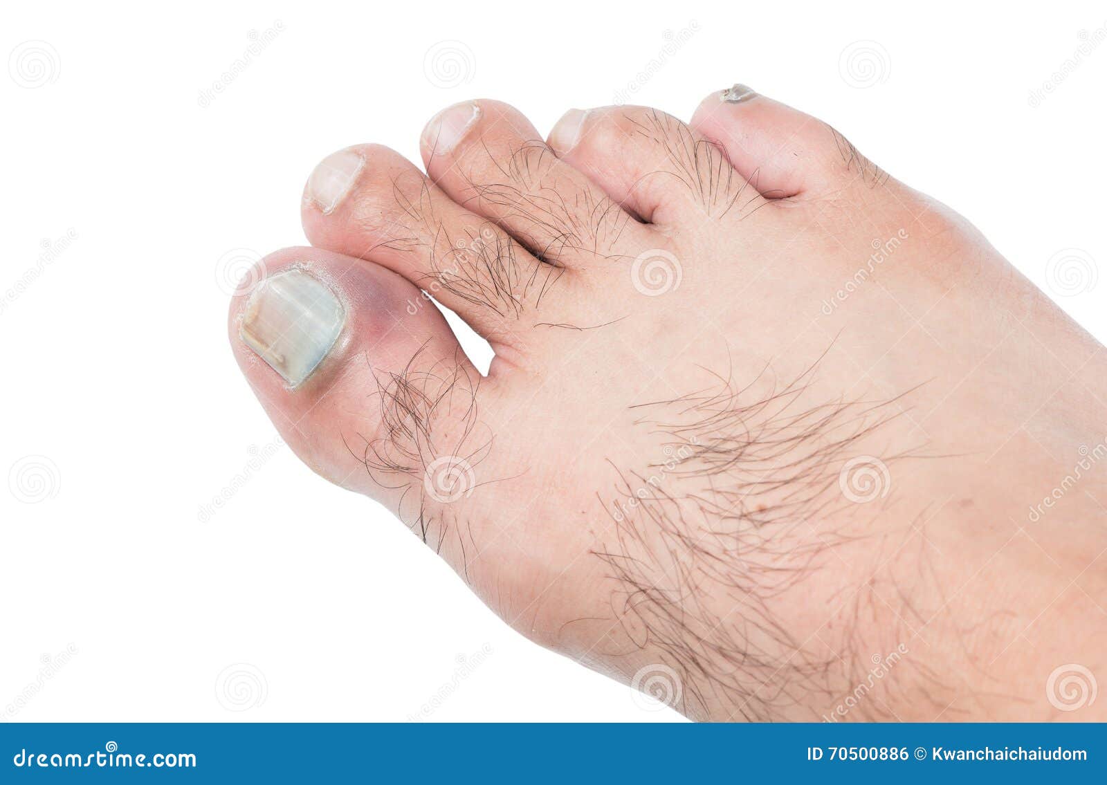 Bruised on toenail stock photo. Image of purple, closeup 70500886