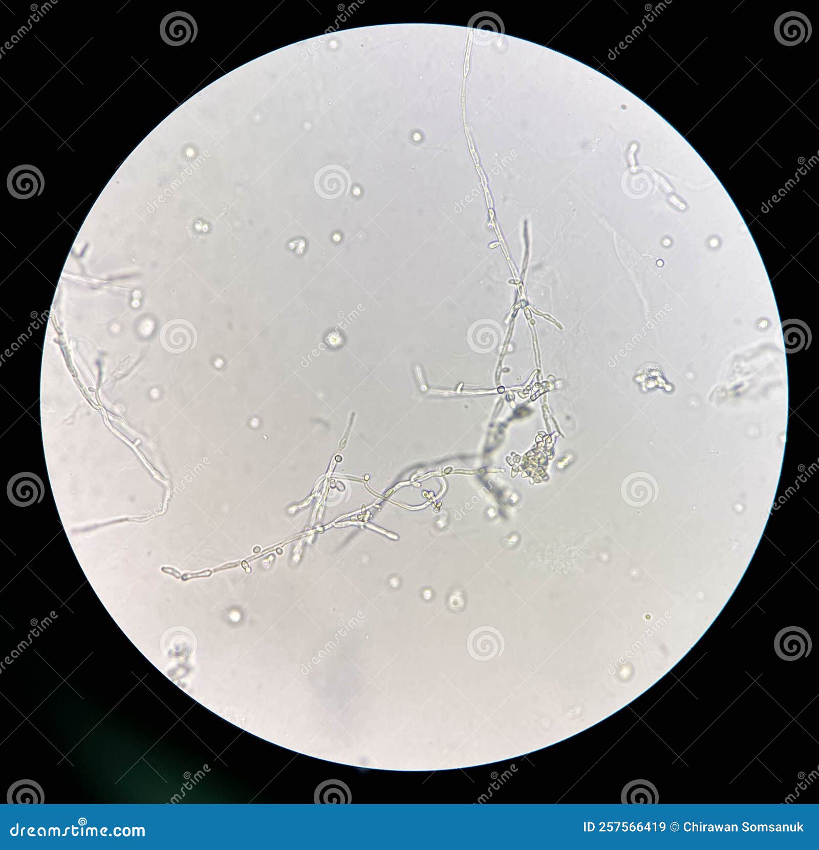 Budding Yeast Cells with Pseudohyphae in Urine Sample Stock Image