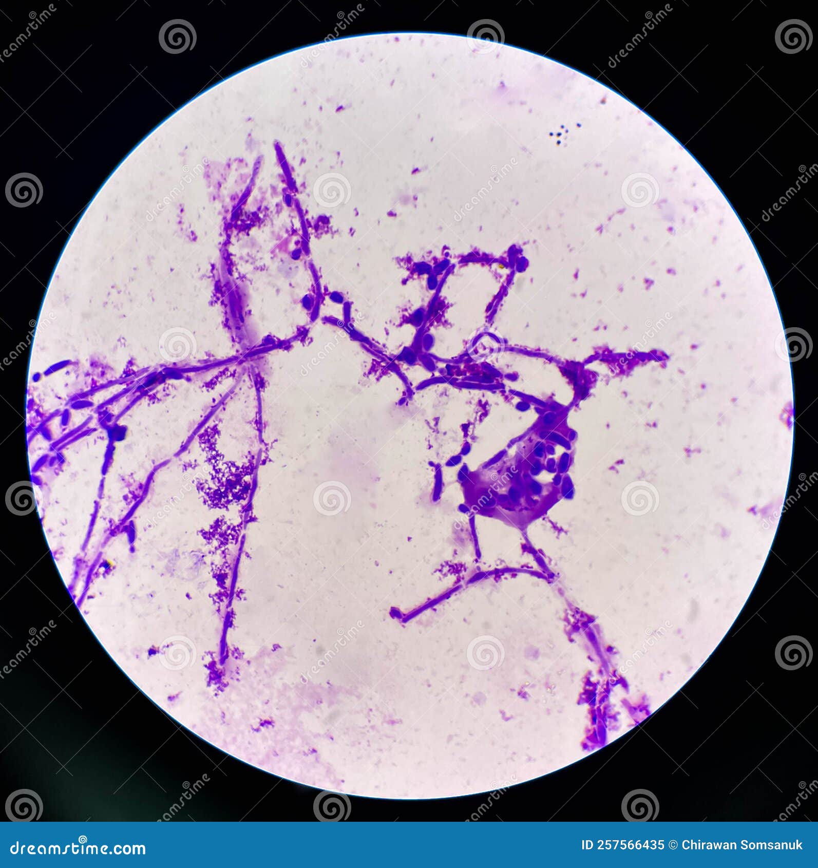 Budding Yeast Cells with Pseudohyphae in Urine Sample on Wright Gimsa