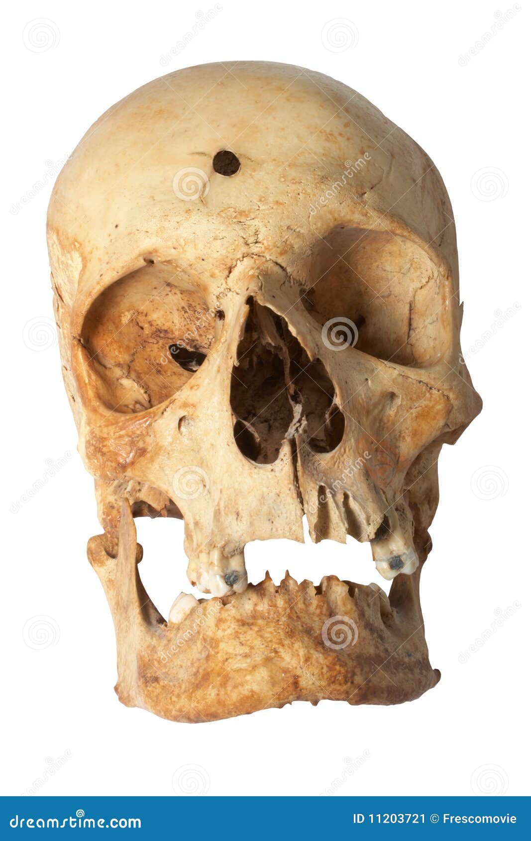 Bullet hole in Human skull stock image. Image of anatomy - 11203721