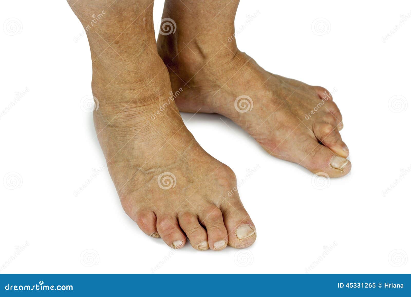 Bunion deformity stock image. Image of treatment, white 45331265