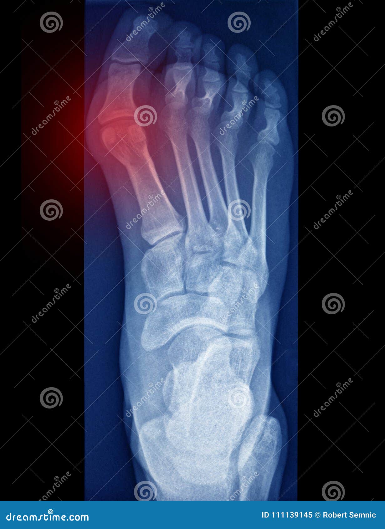 Toe pain, x ray stock image. Image of adult, pain, healthy 111139145