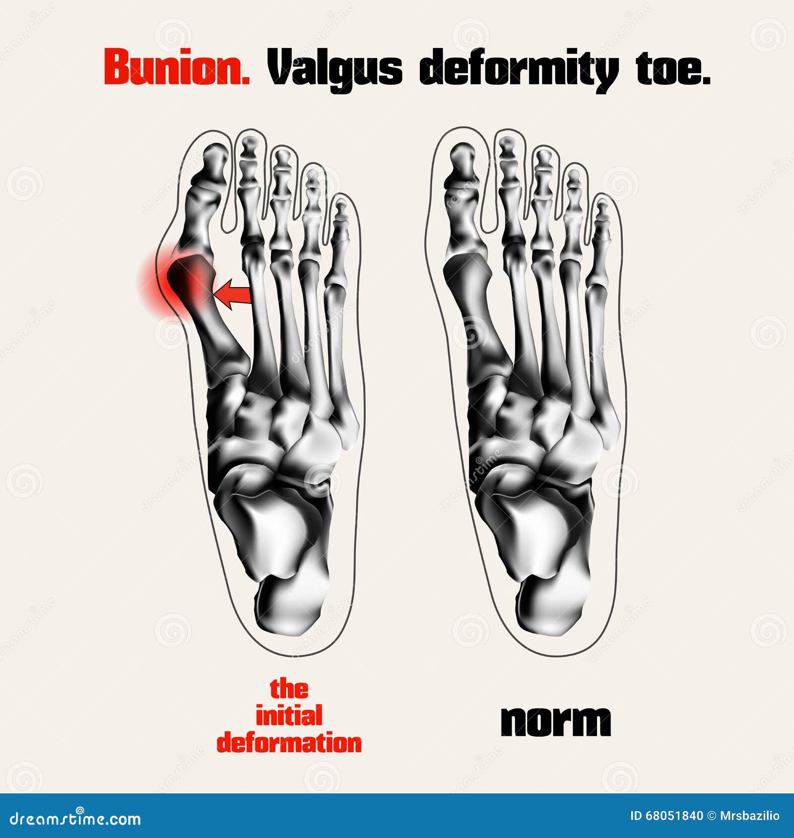 Bunion. Valgus Deformity Toe. Stock Vector - Image: 68051840