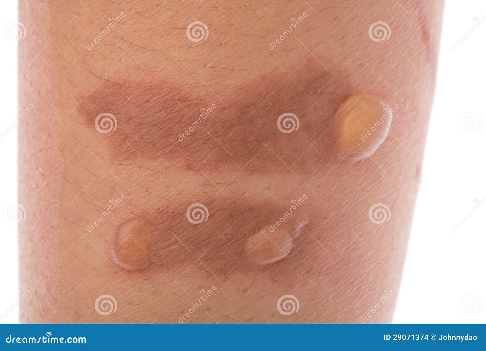 Burn blisters on the skin stock photo. Image of healthcare ...
