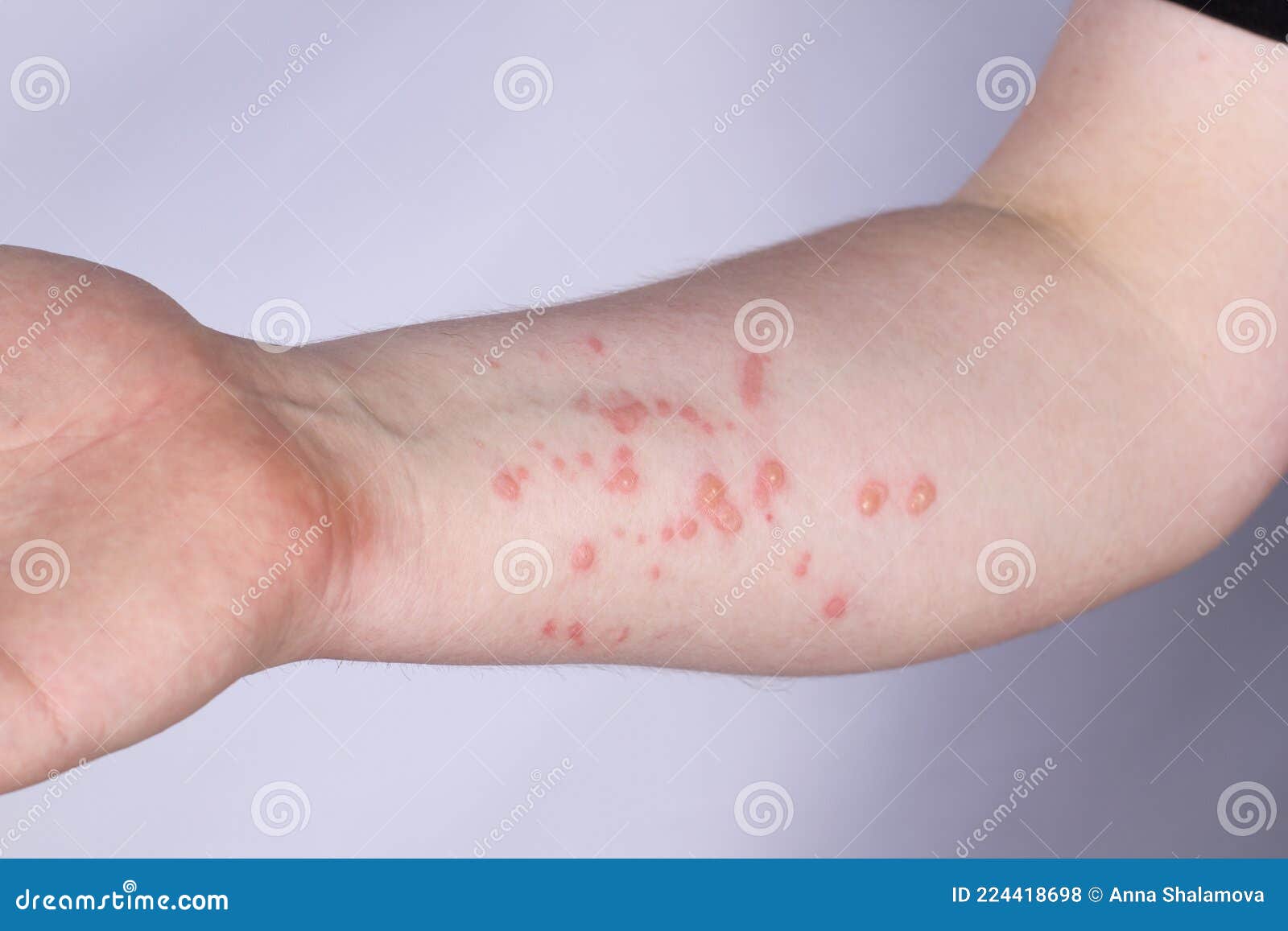 large rash on the guy's hand. monkeypox virus
