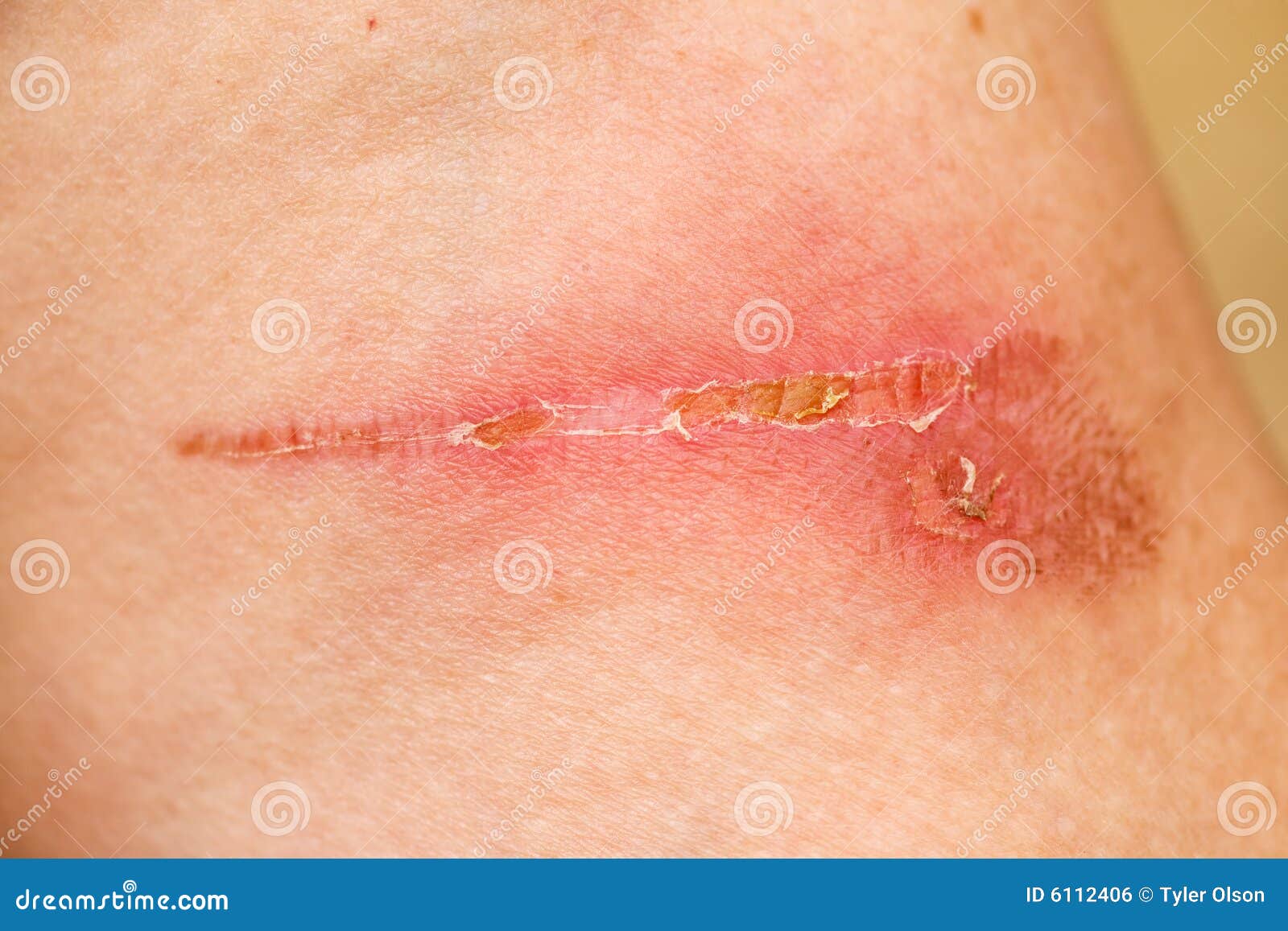 Burn Scar Detail stock photo. Image of painful, flesh 6112406