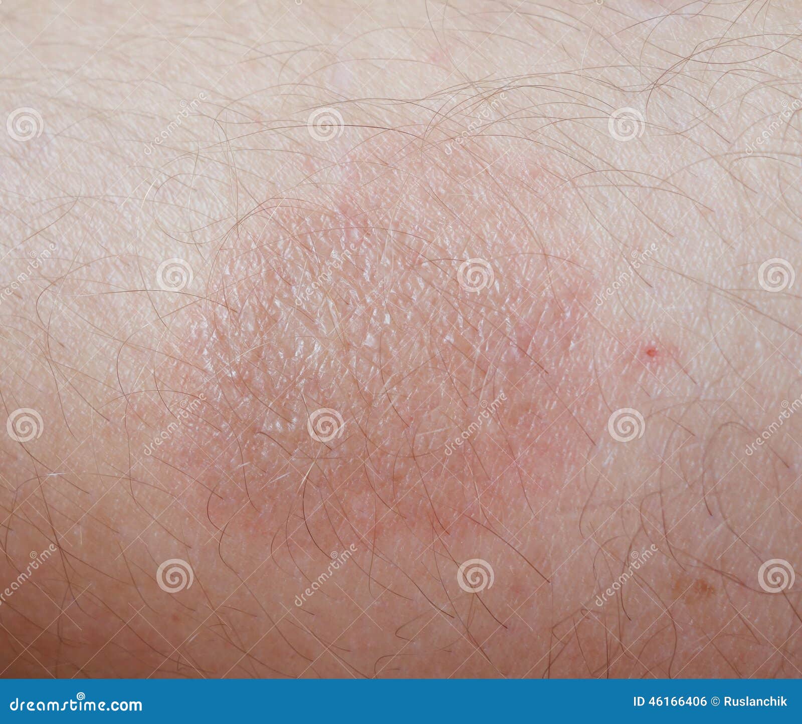 Burn On Skin Stock Photo Image 46166406