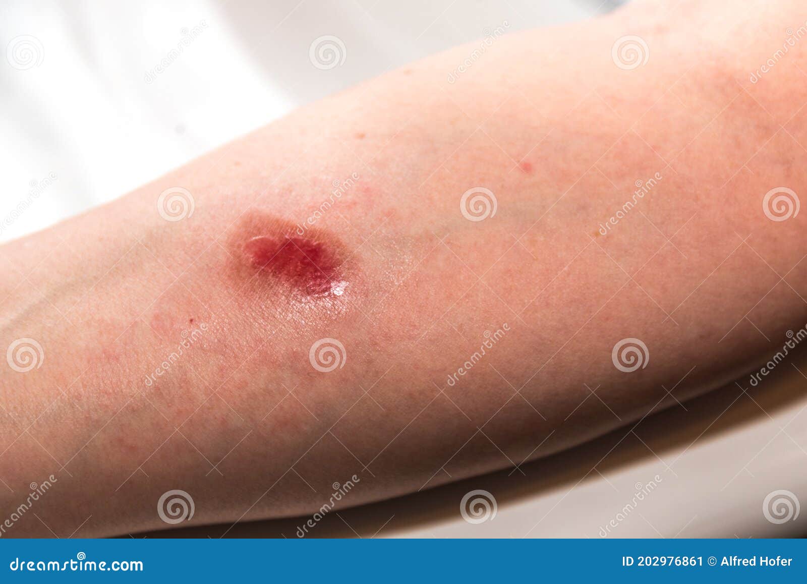 Burn wound scalded arm stock image. Image of pain 202976861