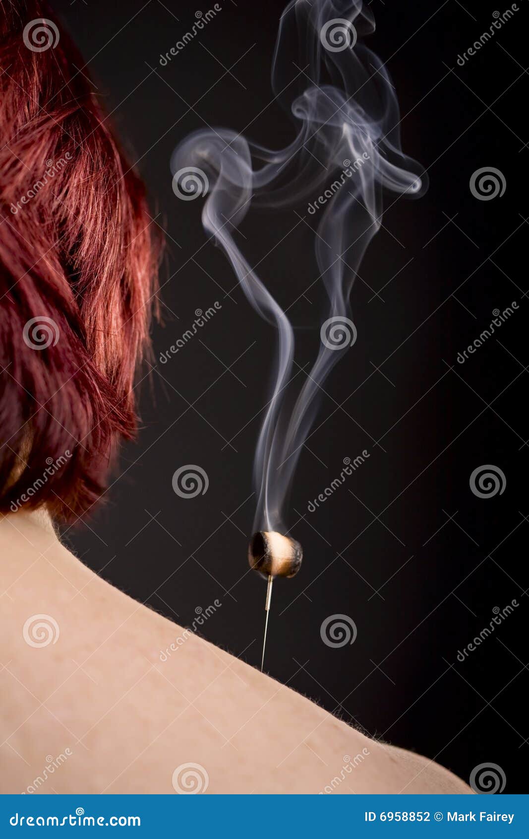 Burning Moxa On Acupuncture Needle Stock Photography Image 6958852