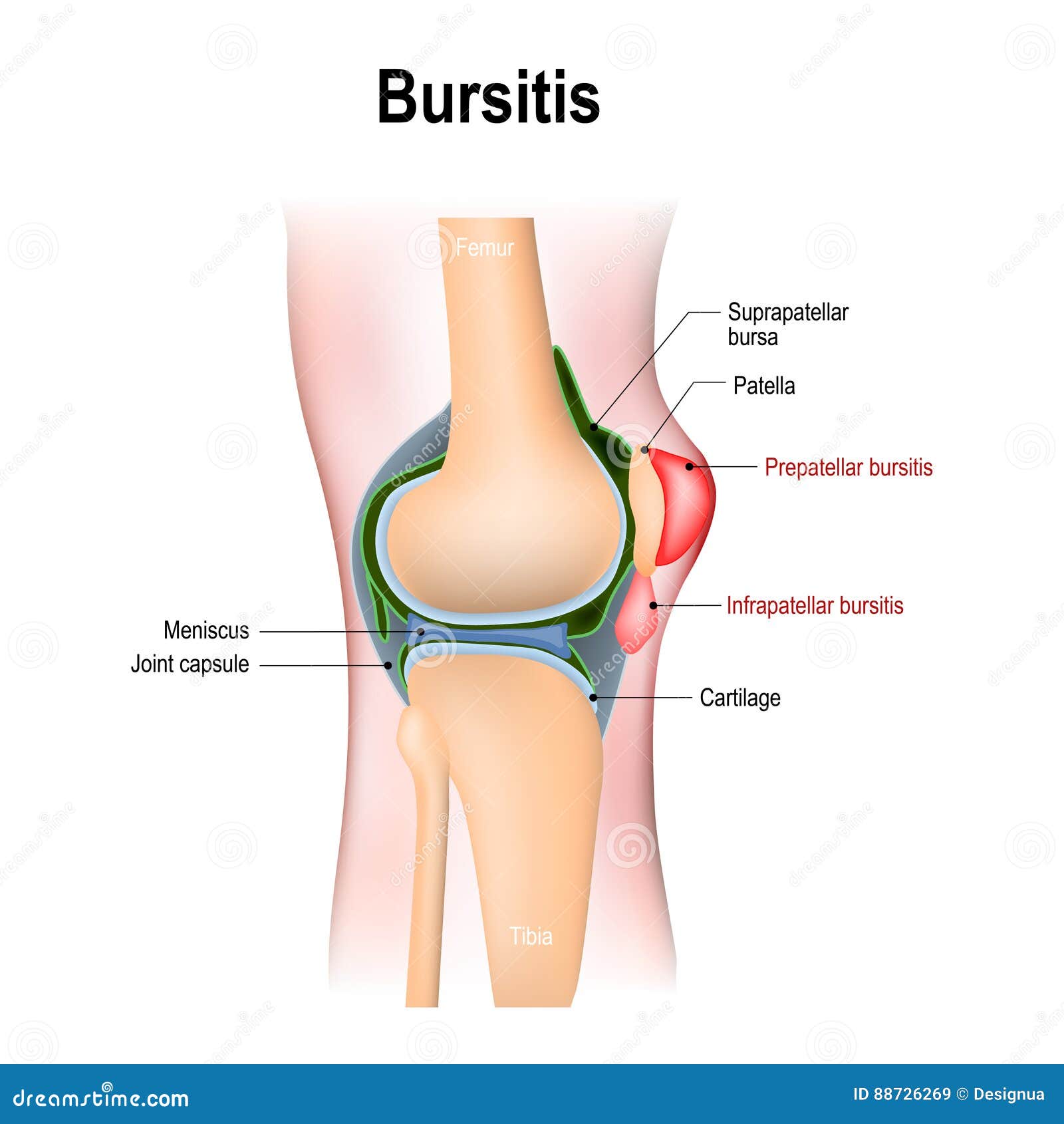 synovial bursa)