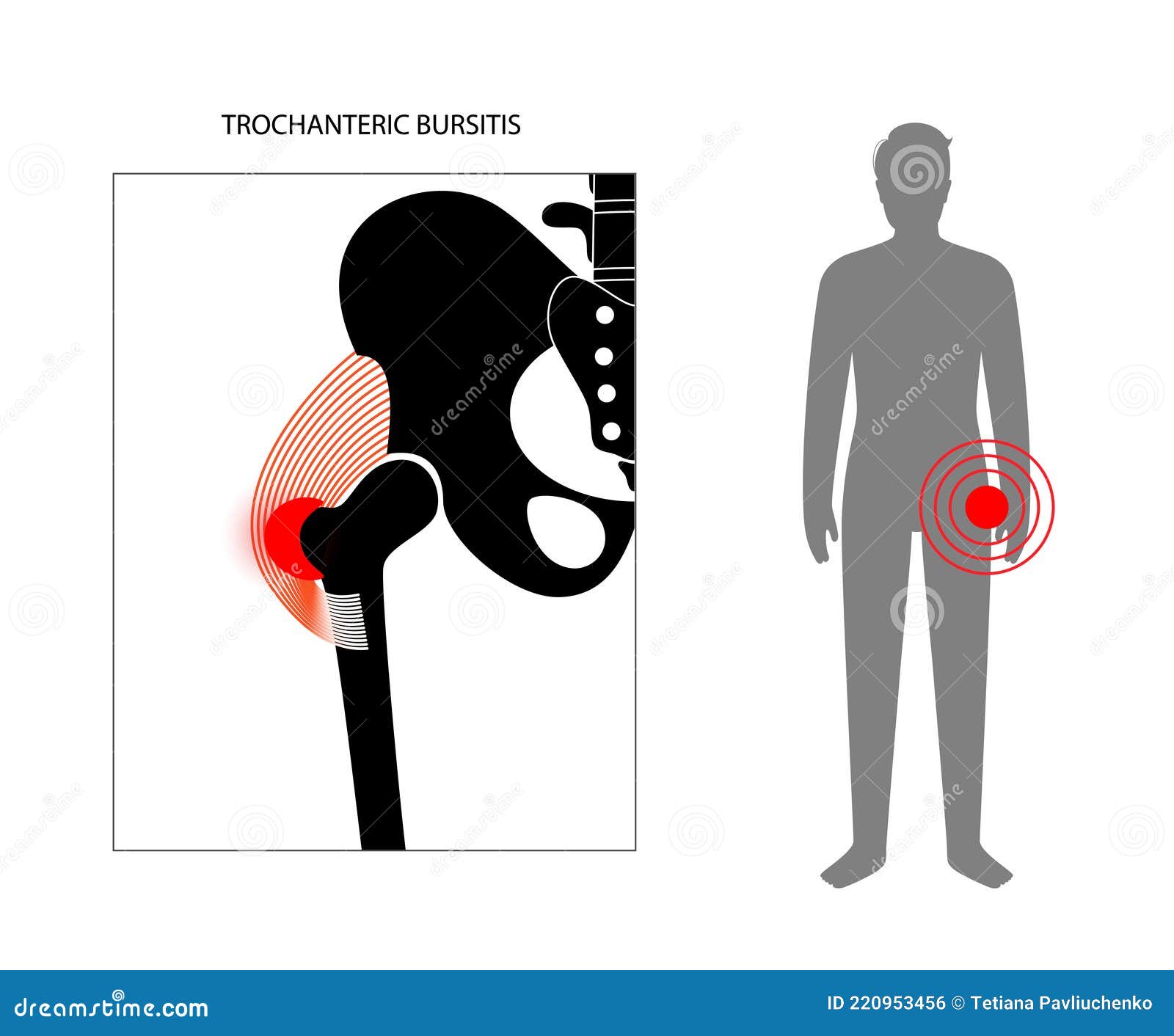 Trochanteric Bursitis As Bursa Inflammation Located In Hip Outline