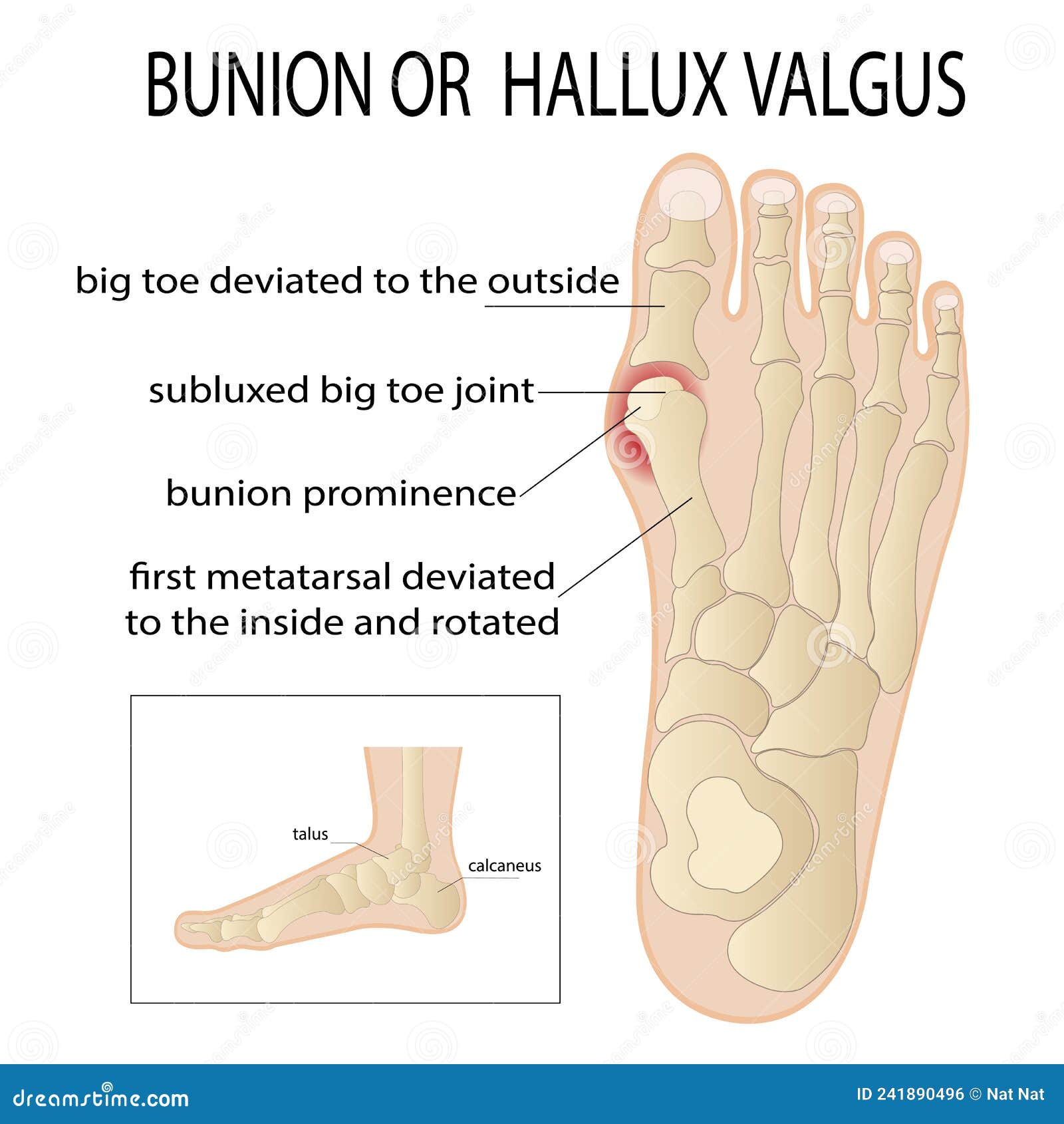 Bursitis on the Sides of the Foot. the Bone and Skin on the Sides of ...